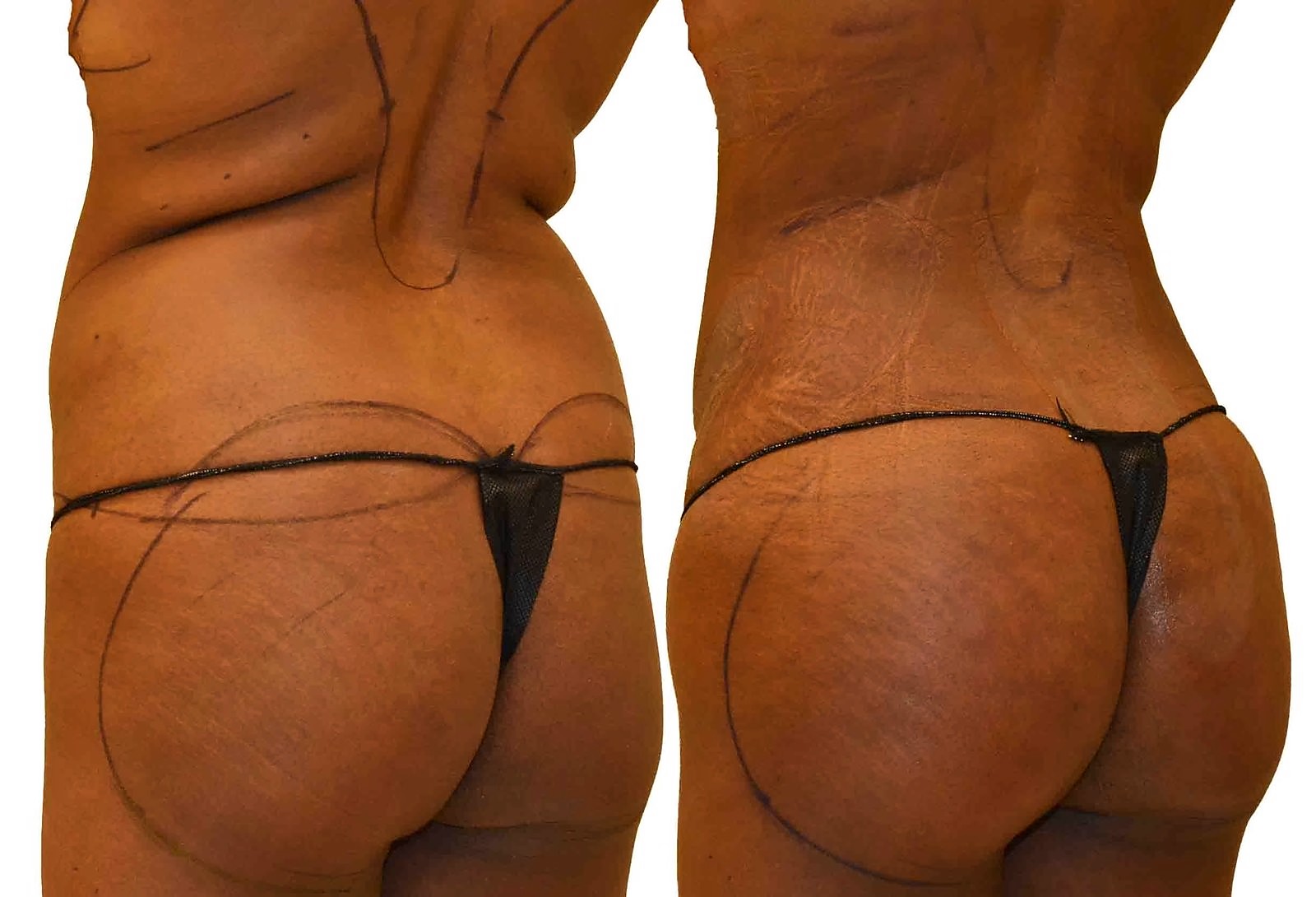 Before/After Fat Transfer, BBL before and after, actual patient of Dr. Long
