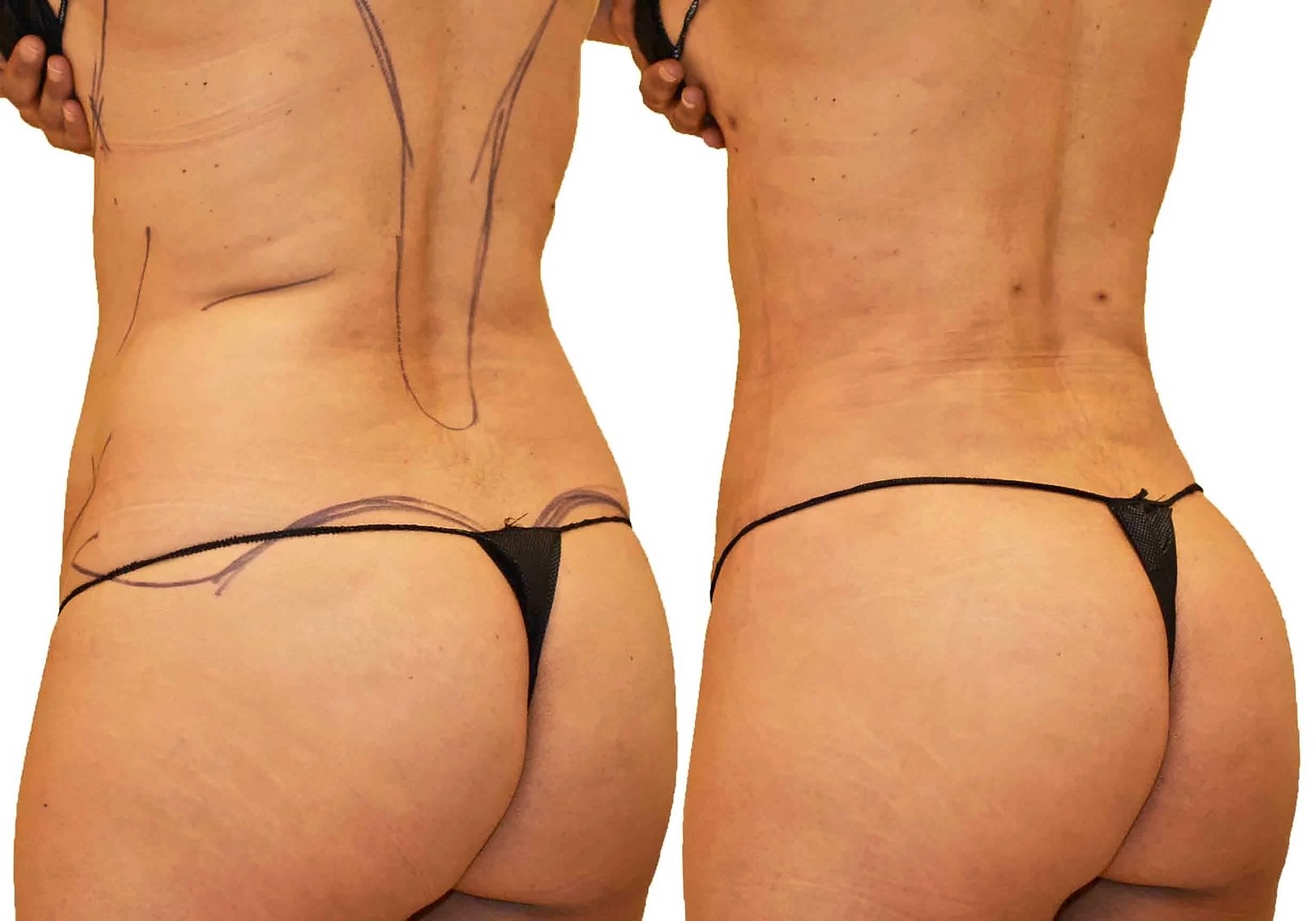 Before/After Fat Transfer, BBL before and after, actual patient of Dr. Long