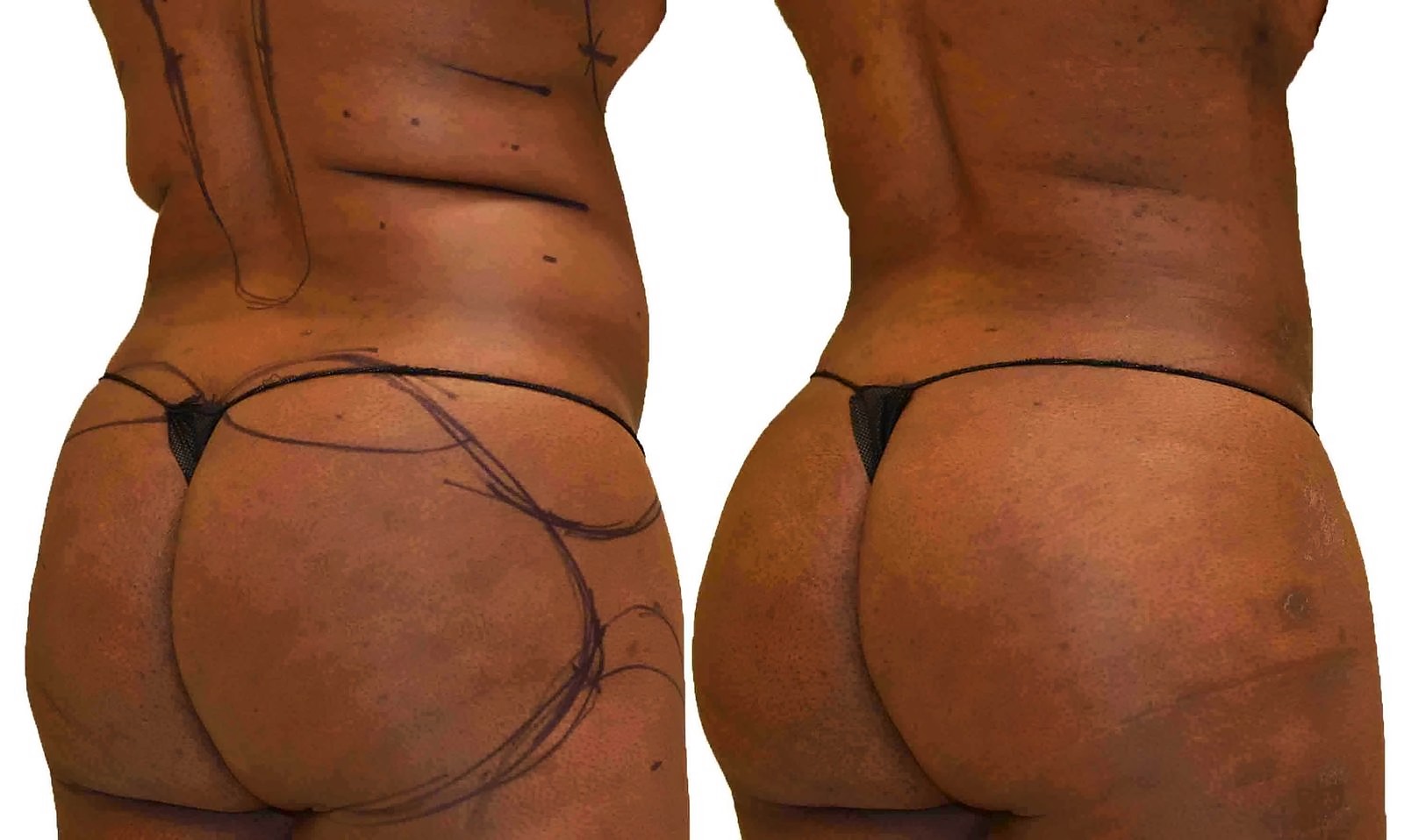 Before/After Fat Transfer, BBL before and after, actual patient of Dr. Long