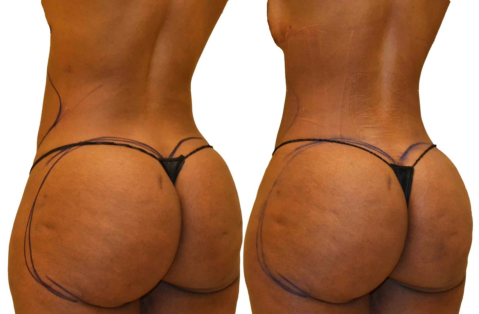 Before/After Fat Transfer, BBL before and after, actual patient of Dr. Long