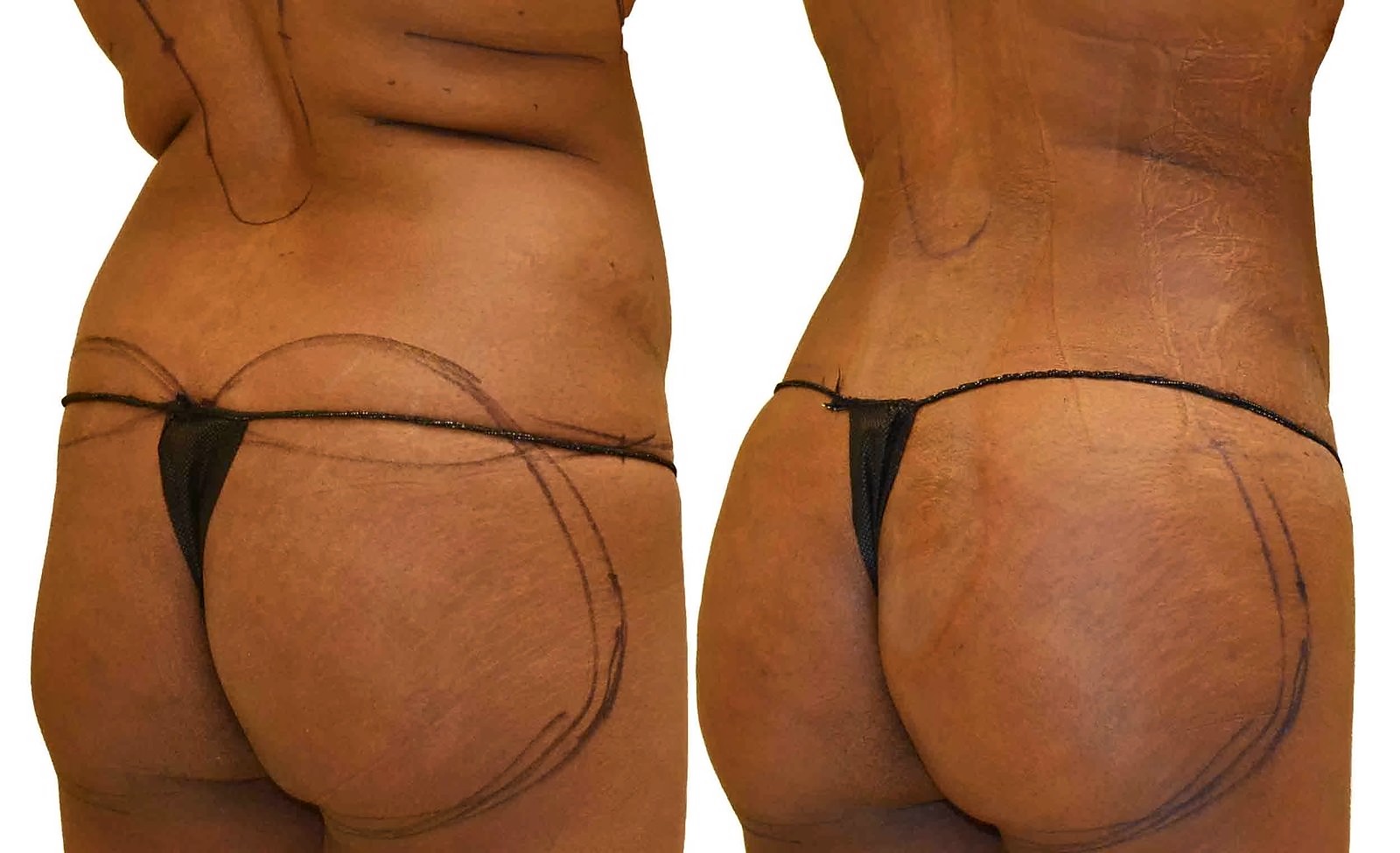 Before/After Fat Transfer, BBL before and after, actual patient of Dr. Long