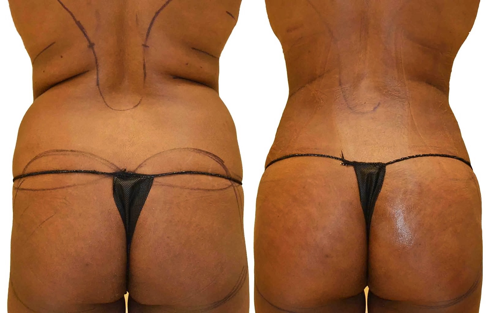 Before/After Fat Transfer, BBL before and after, actual patient of Dr. Long