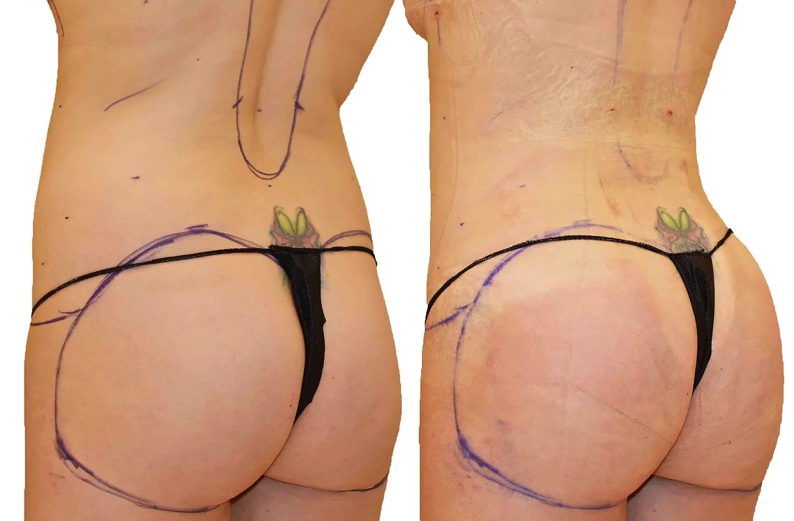 Before/After Fat Transfer, BBL before and after, actual patient of Dr. Long