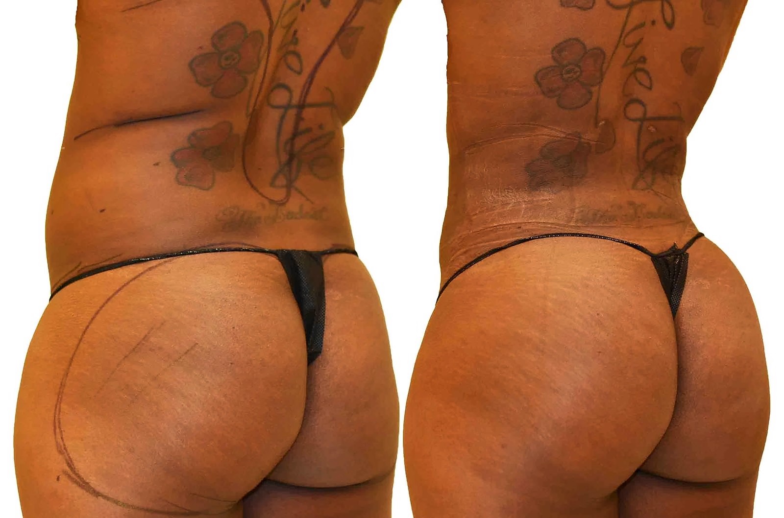 Before/After Fat Transfer, BBL before and after, actual patient of Dr. Long