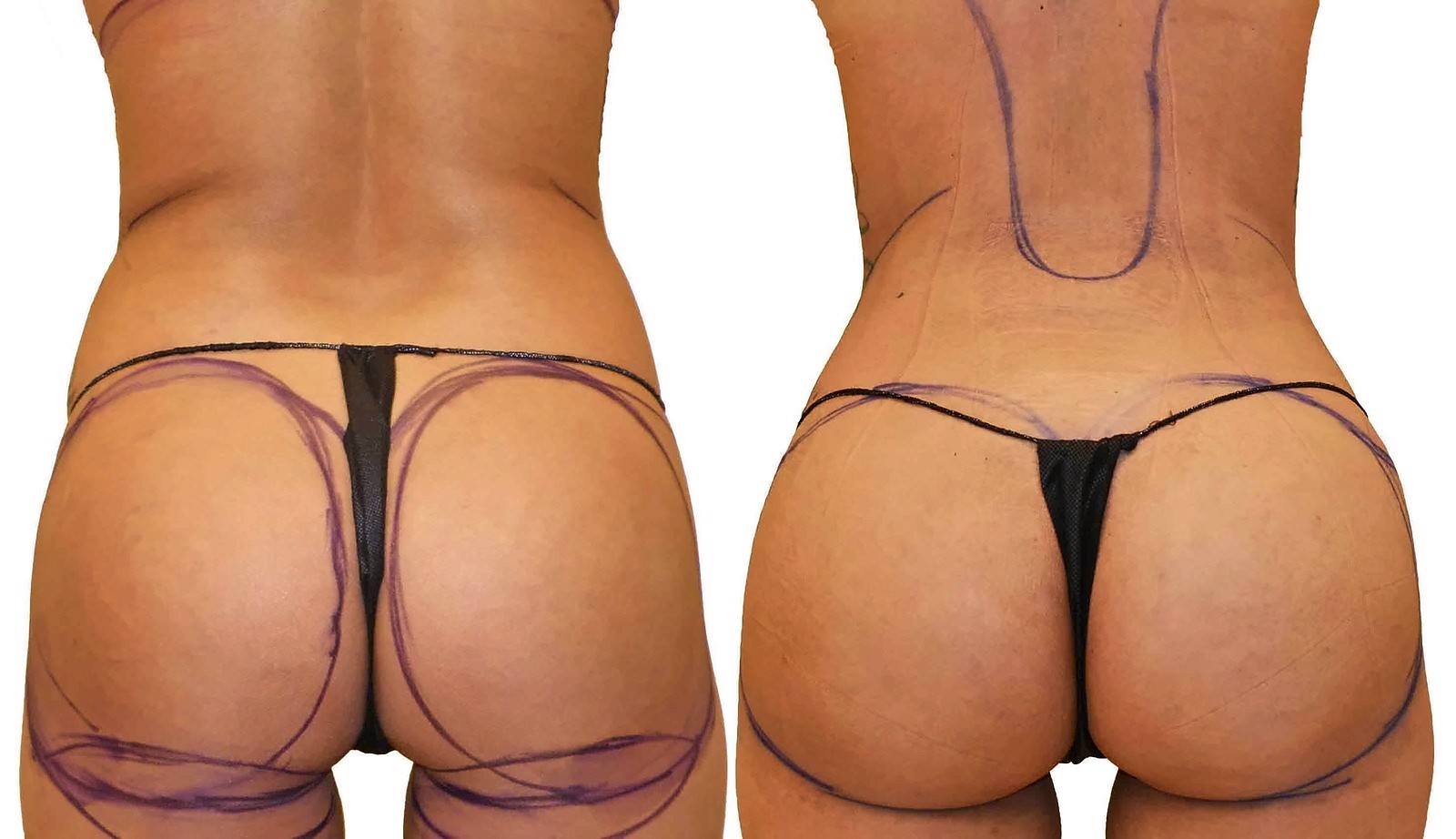 Before/After Fat Transfer, BBL before and after, actual patient of Dr. Long