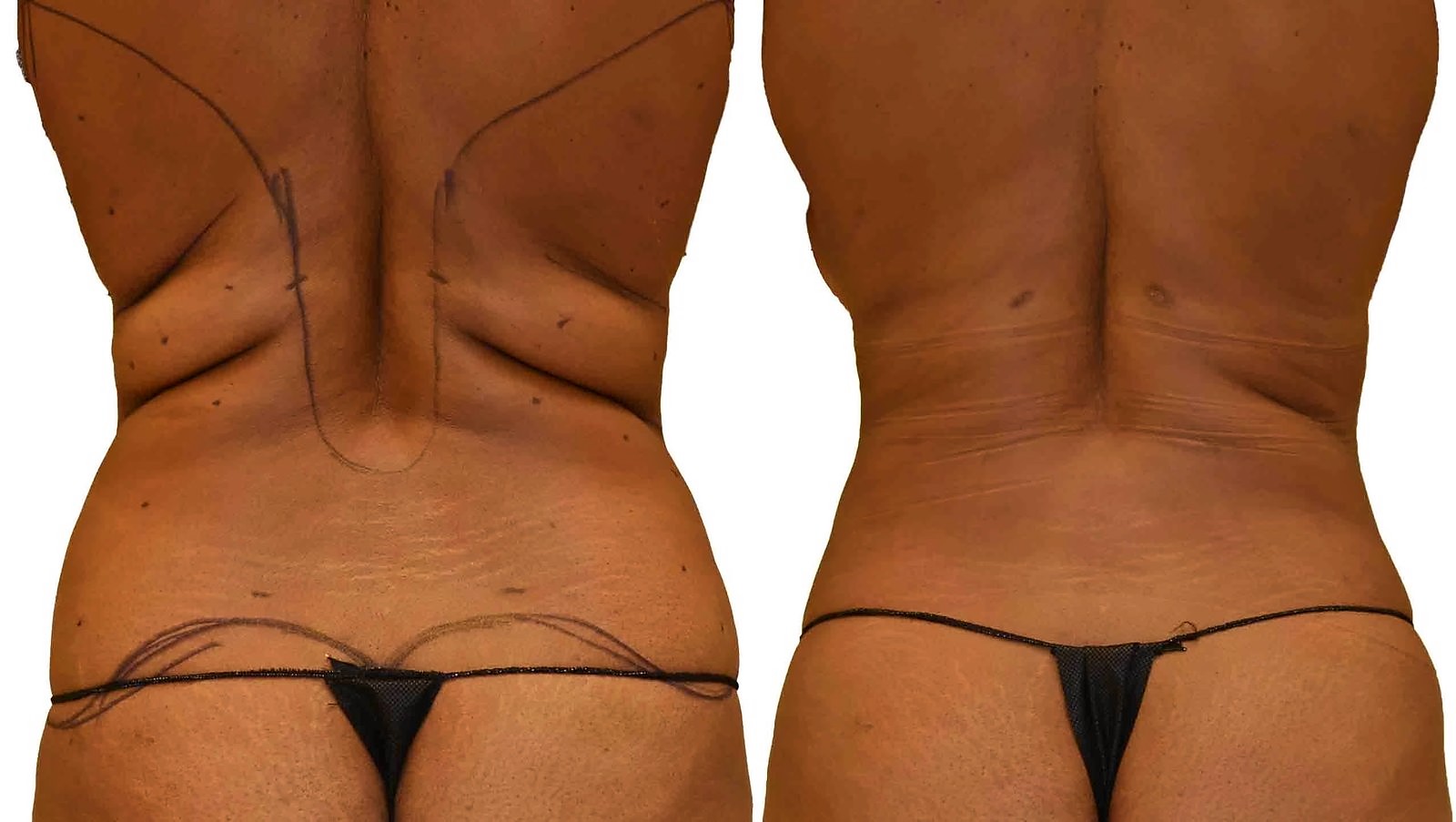 Before/After Fat Transfer, BBL before and after, actual patient of Dr. Long