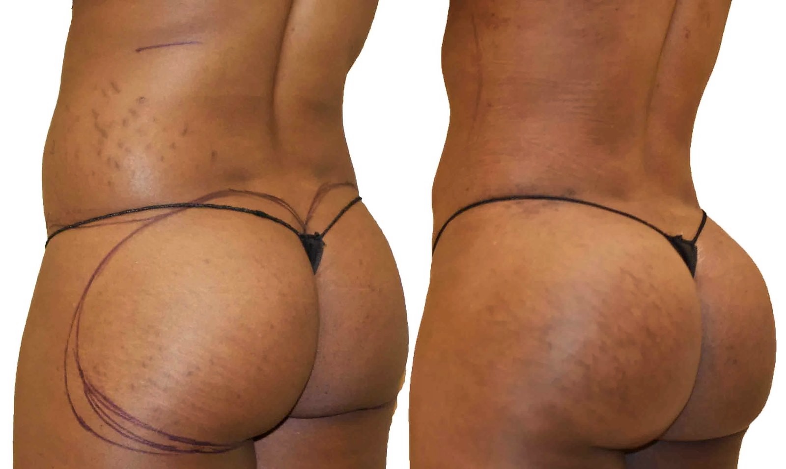 Before/After Fat Transfer, BBL before and after, actual patient of Dr. Long