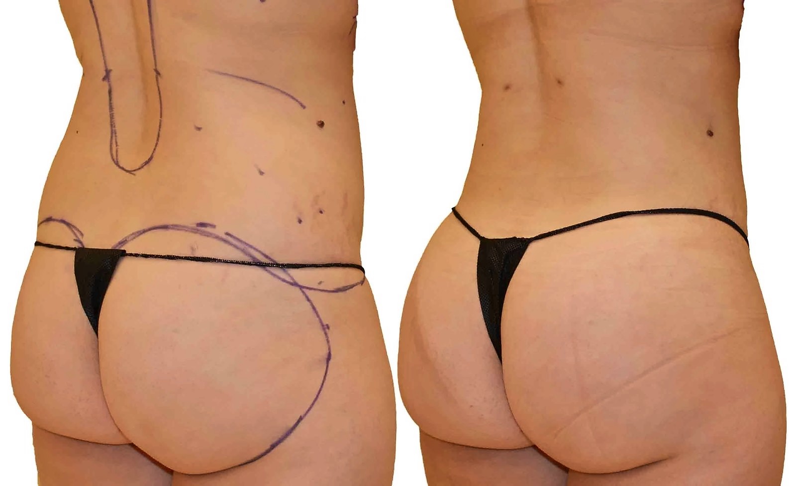 Before/After Fat Transfer, BBL before and after, actual patient of Dr. Long