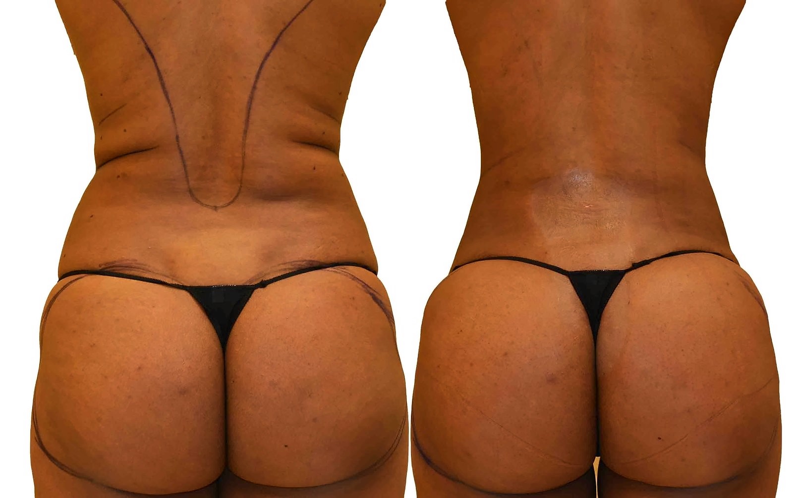 Before/After Fat Transfer, BBL before and after, actual patient of Dr. Long