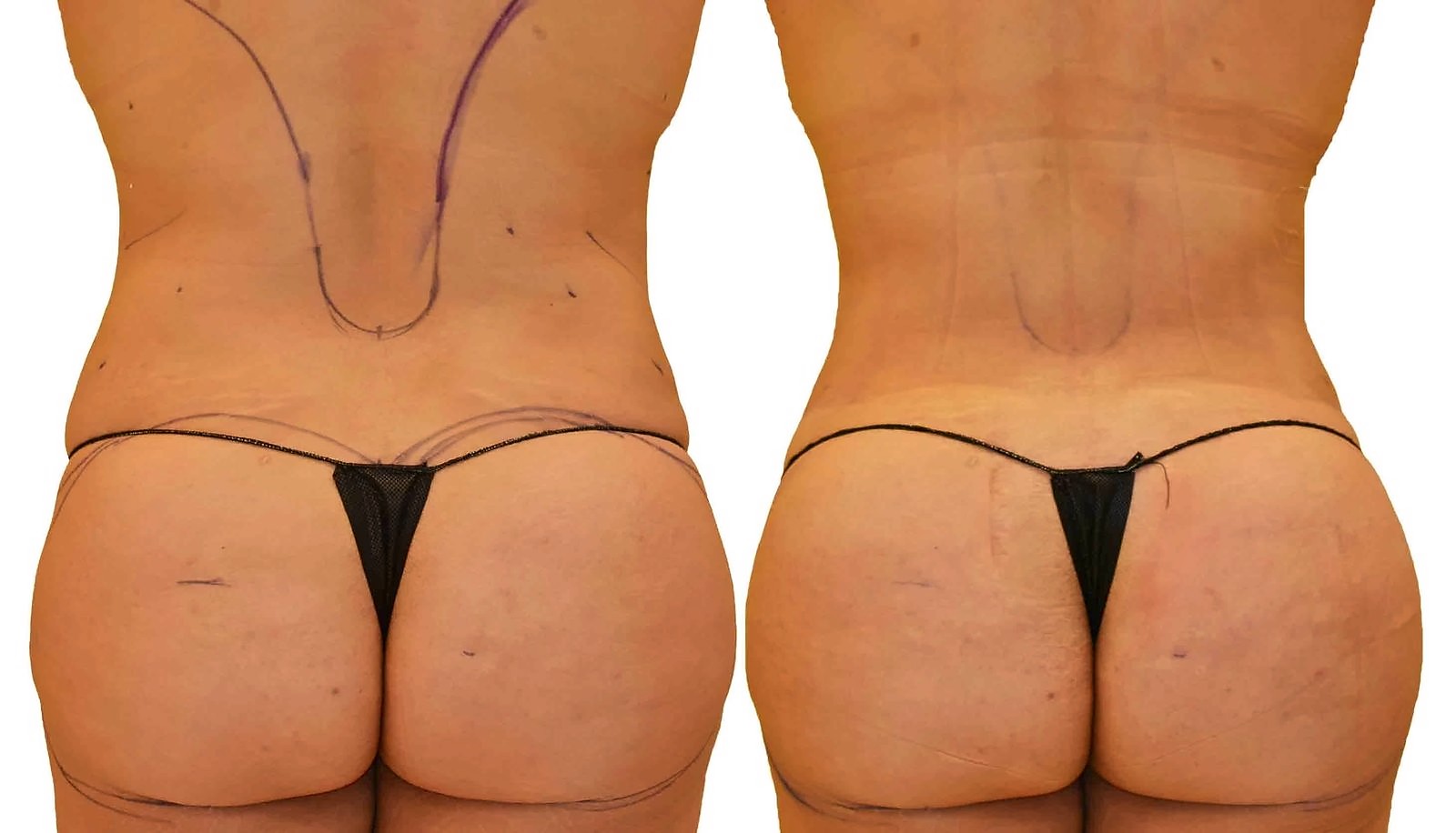 Before/After Fat Transfer, BBL before and after, actual patient of Dr. Long