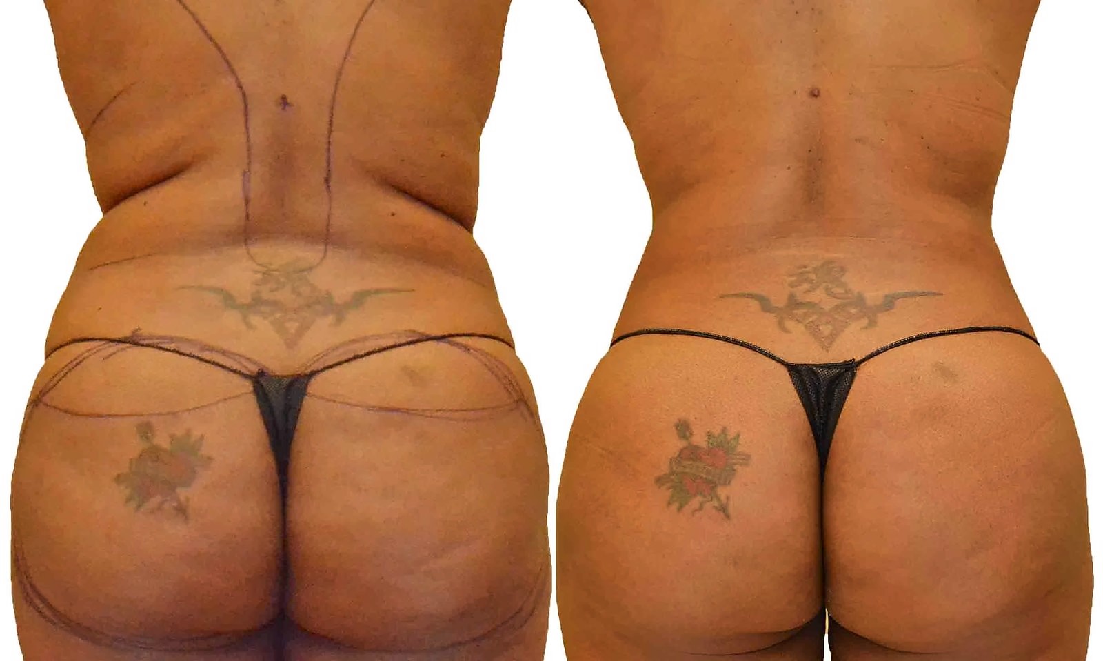 Before/After Fat Transfer, BBL before and after, actual patient of Dr. Long