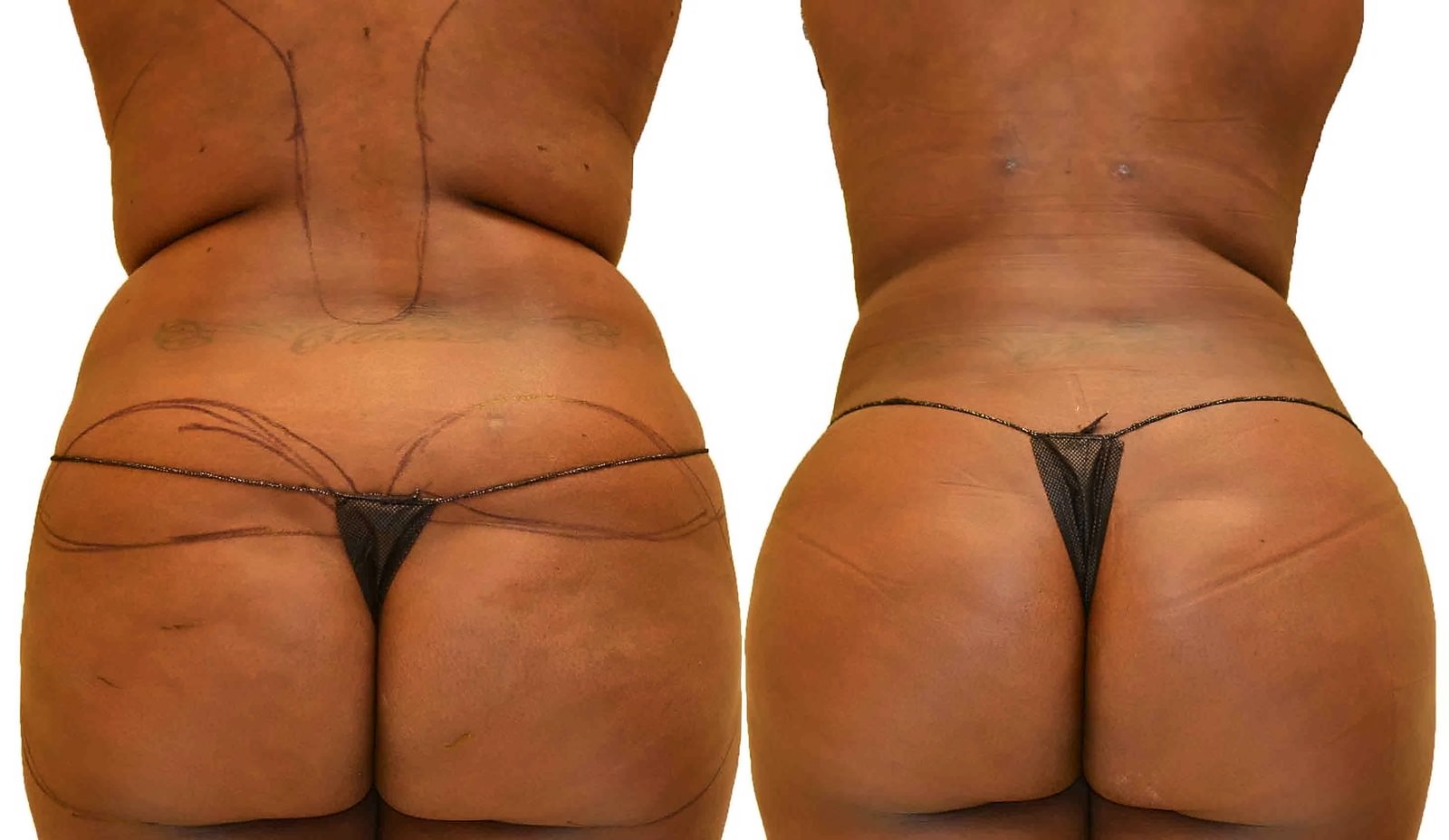 Before/After Fat Transfer, BBL before and after, actual patient of Dr. Long