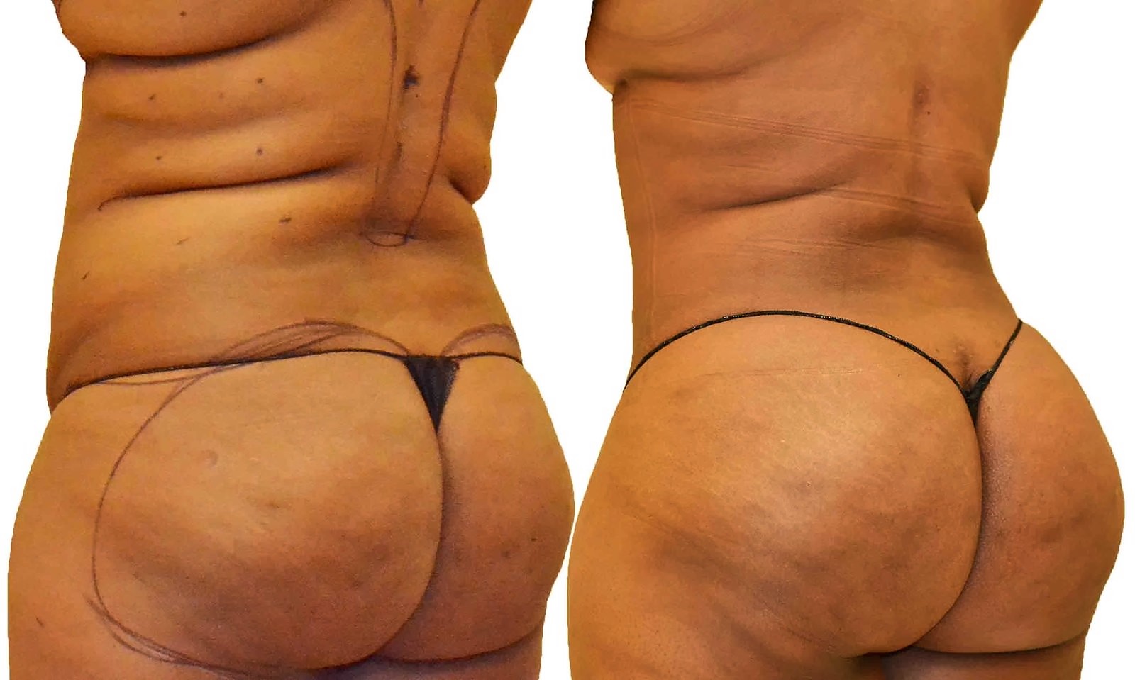 Before/After Fat Transfer, BBL before and after, actual patient of Dr. Long