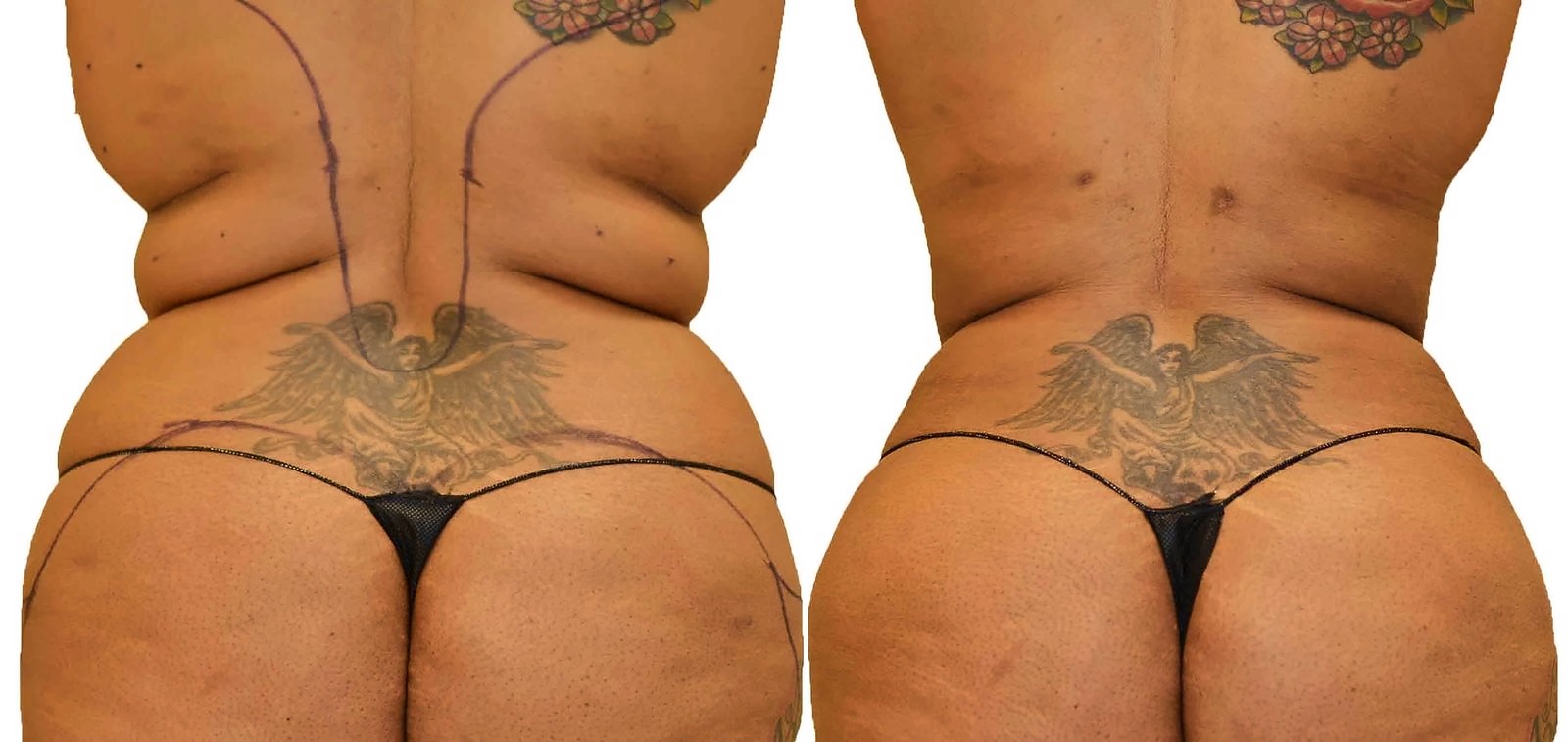 Before/After Fat Transfer, BBL before and after, actual patient of Dr. Long