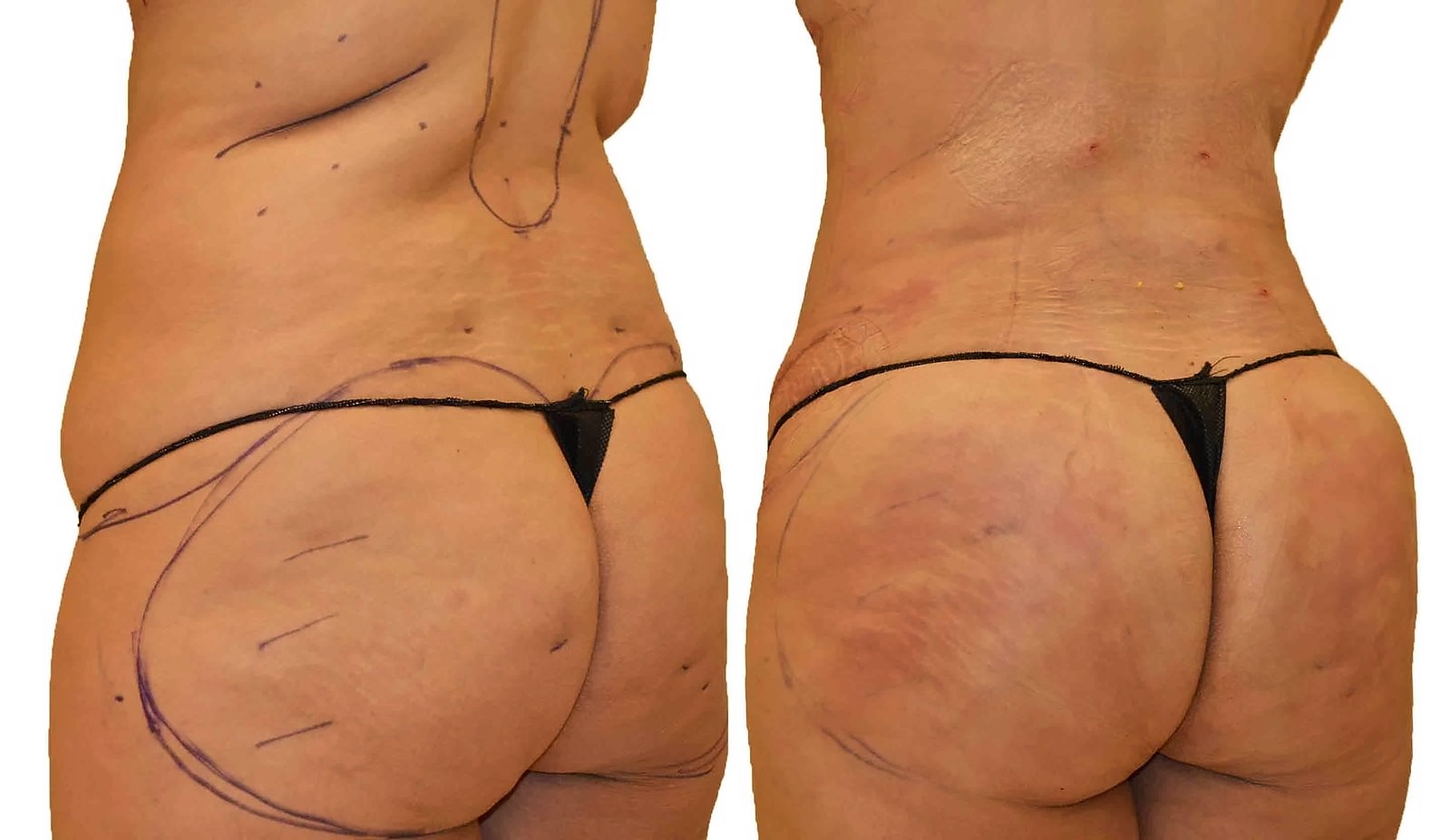 Before/After Fat Transfer, BBL before and after, actual patient of Dr. Long