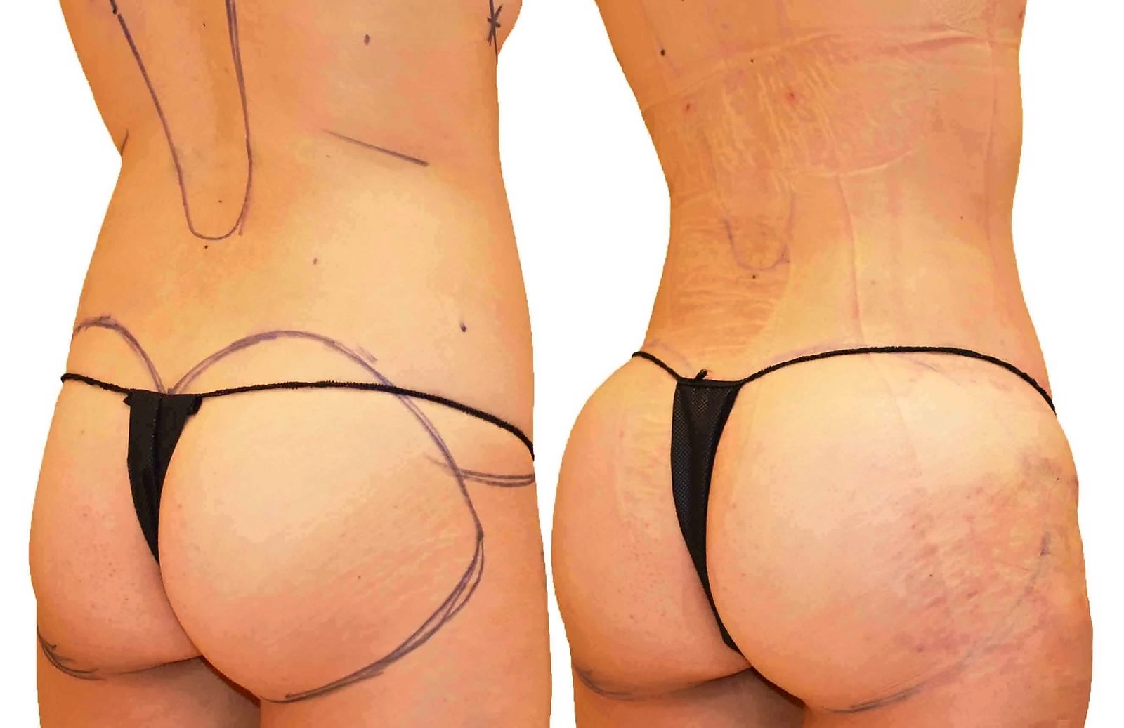 Before/After Fat Transfer, BBL before and after, actual patient of Dr. Long