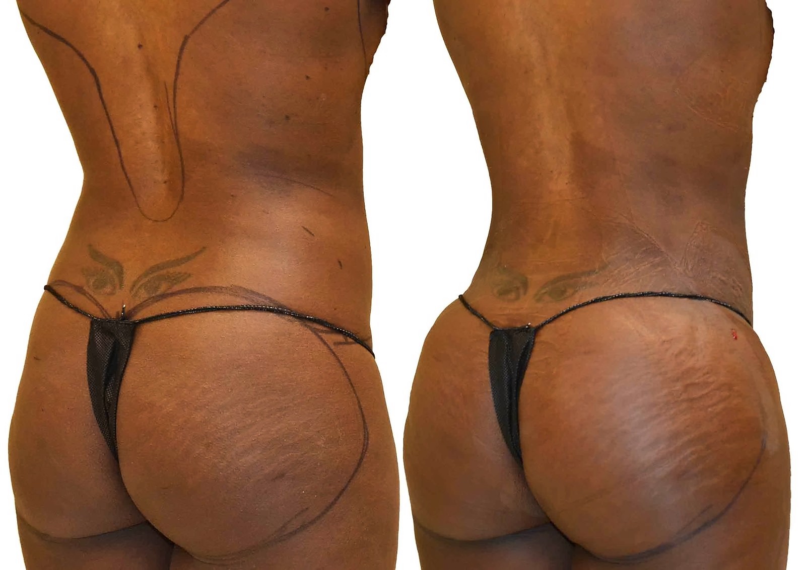 Before/After Fat Transfer, BBL before and after, actual patient of Dr. Long