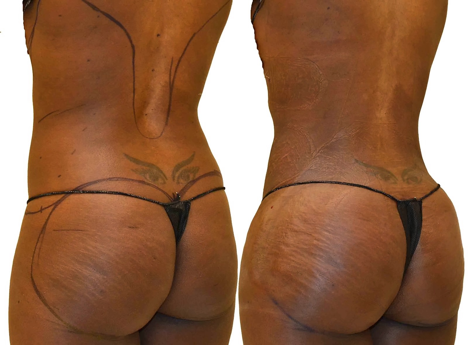 Before/After Fat Transfer, BBL before and after, actual patient of Dr. Long
