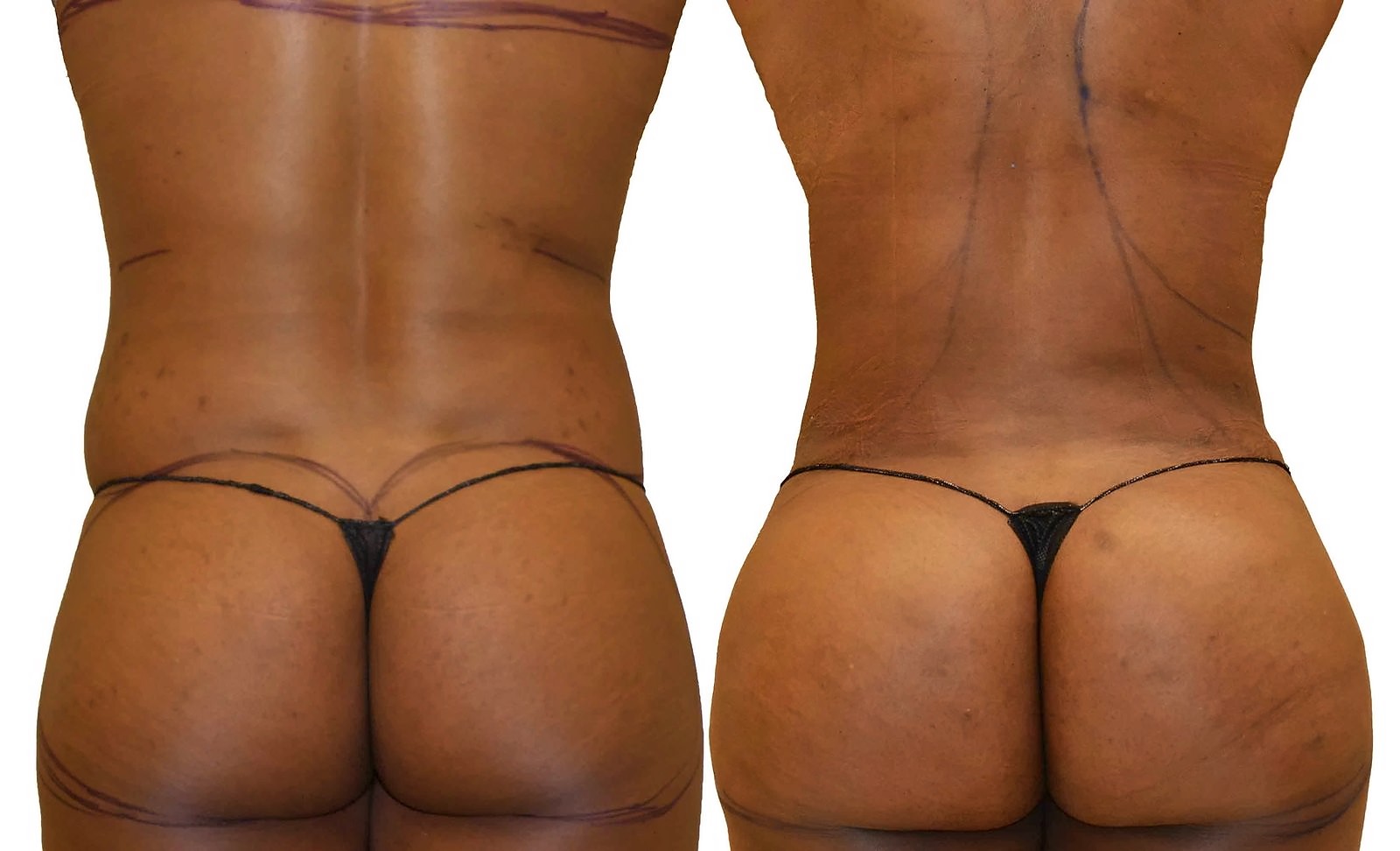 Before/After Fat Transfer, BBL before and after, actual patient of Dr. Long