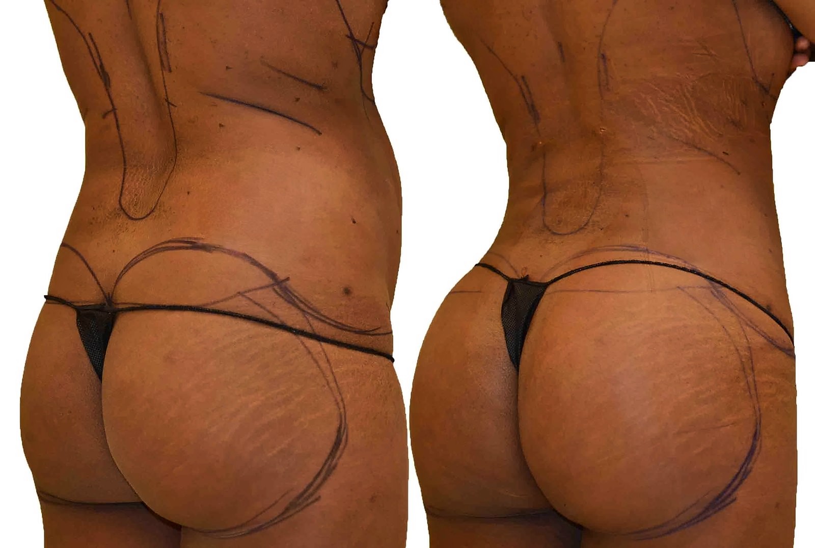Before/After Fat Transfer, BBL before and after, actual patient of Dr. Long