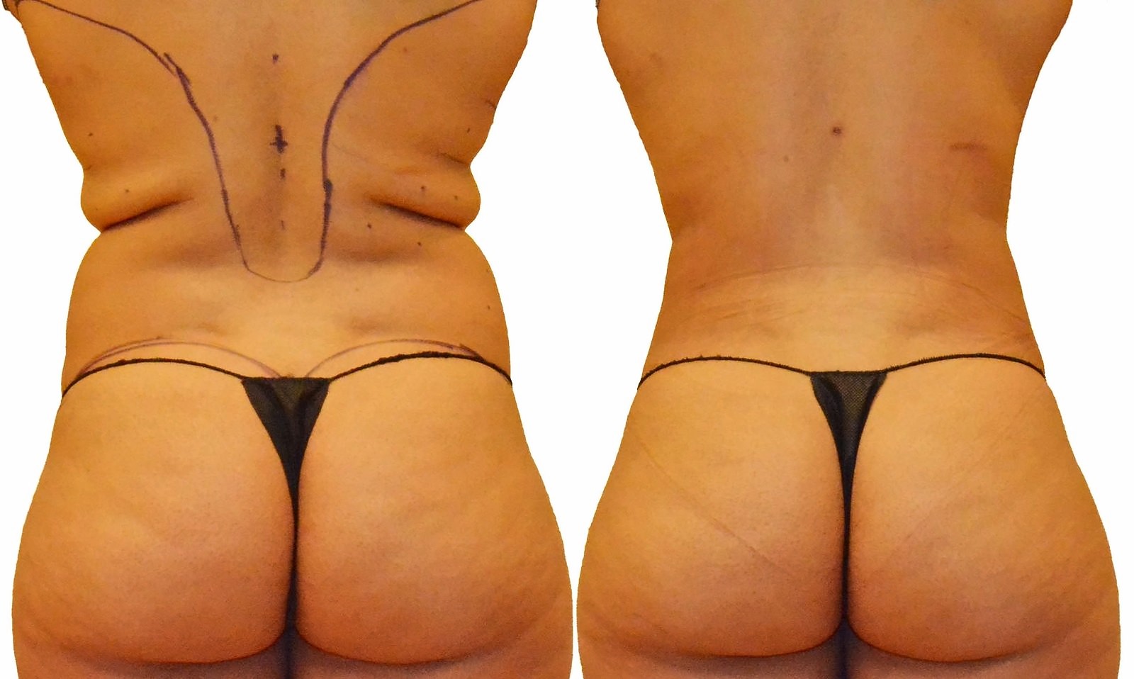 Before/After Fat Transfer, BBL before and after, actual patient of Dr. Long
