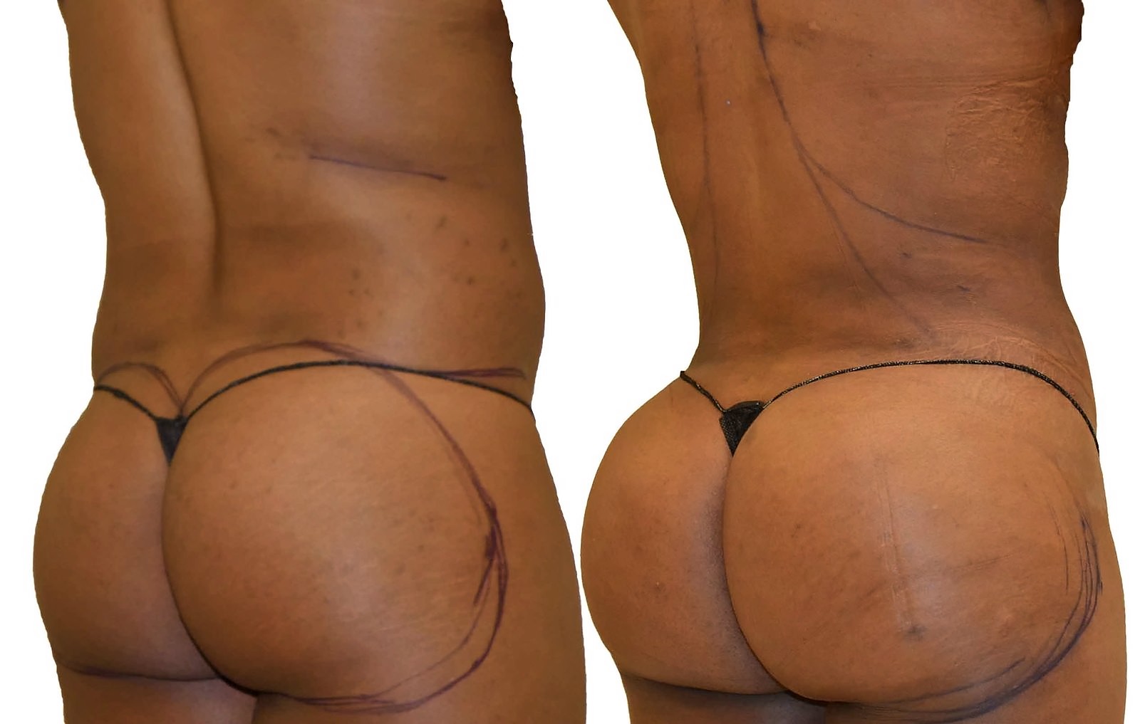 Before/After Fat Transfer, BBL before and after, actual patient of Dr. Long
