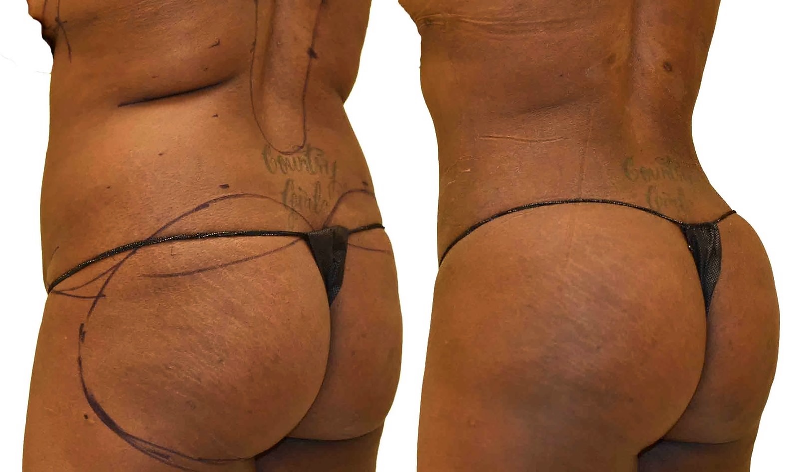 Before/After Fat Transfer, BBL before and after, actual patient of Dr. Long