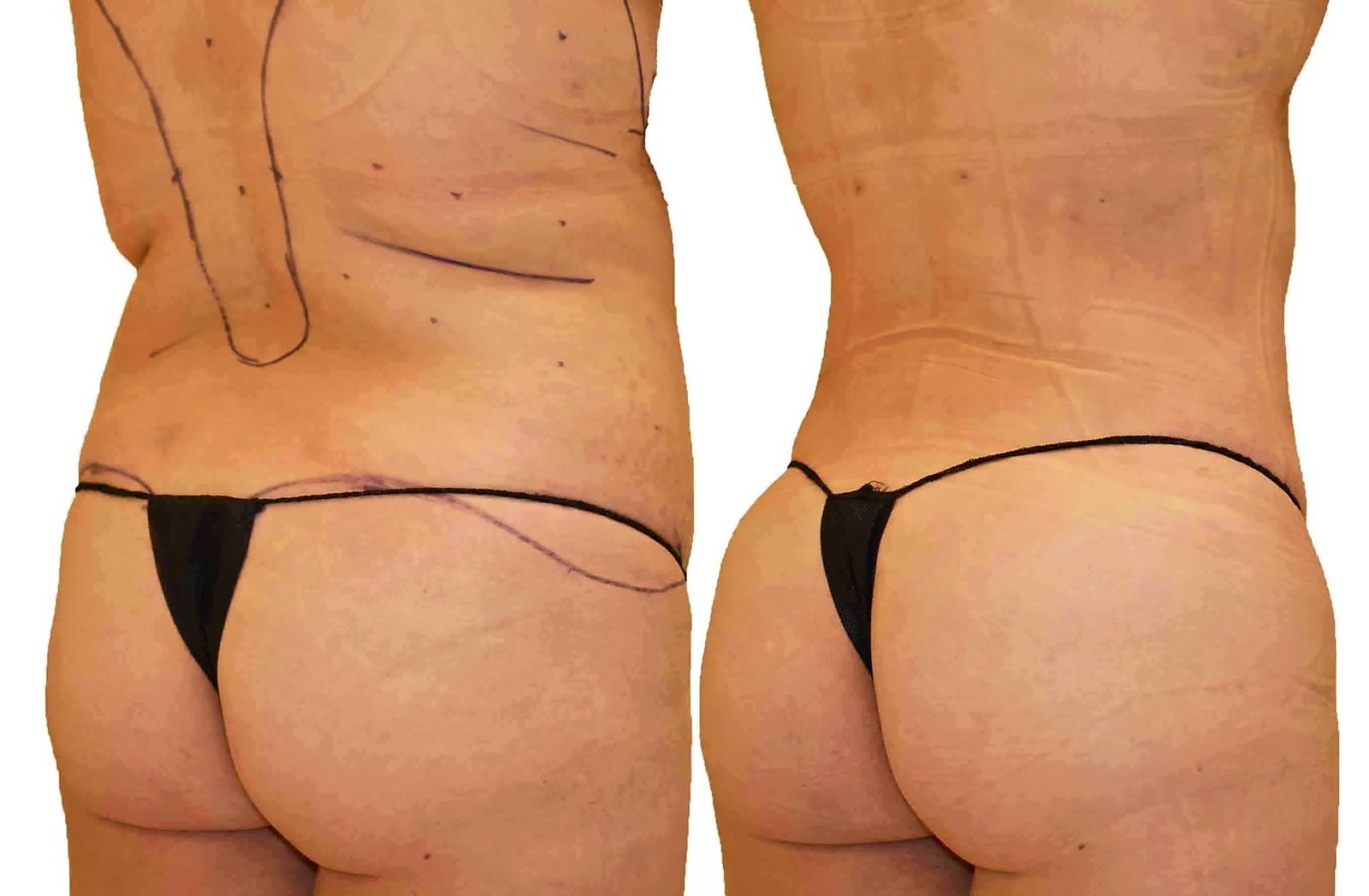 Before/After Fat Transfer, BBL before and after, actual patient of Dr. Long