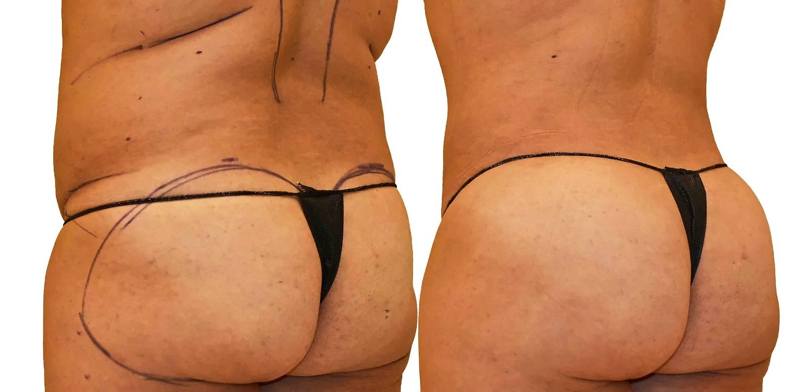 Before/After Fat Transfer, BBL before and after, actual patient of Dr. Long