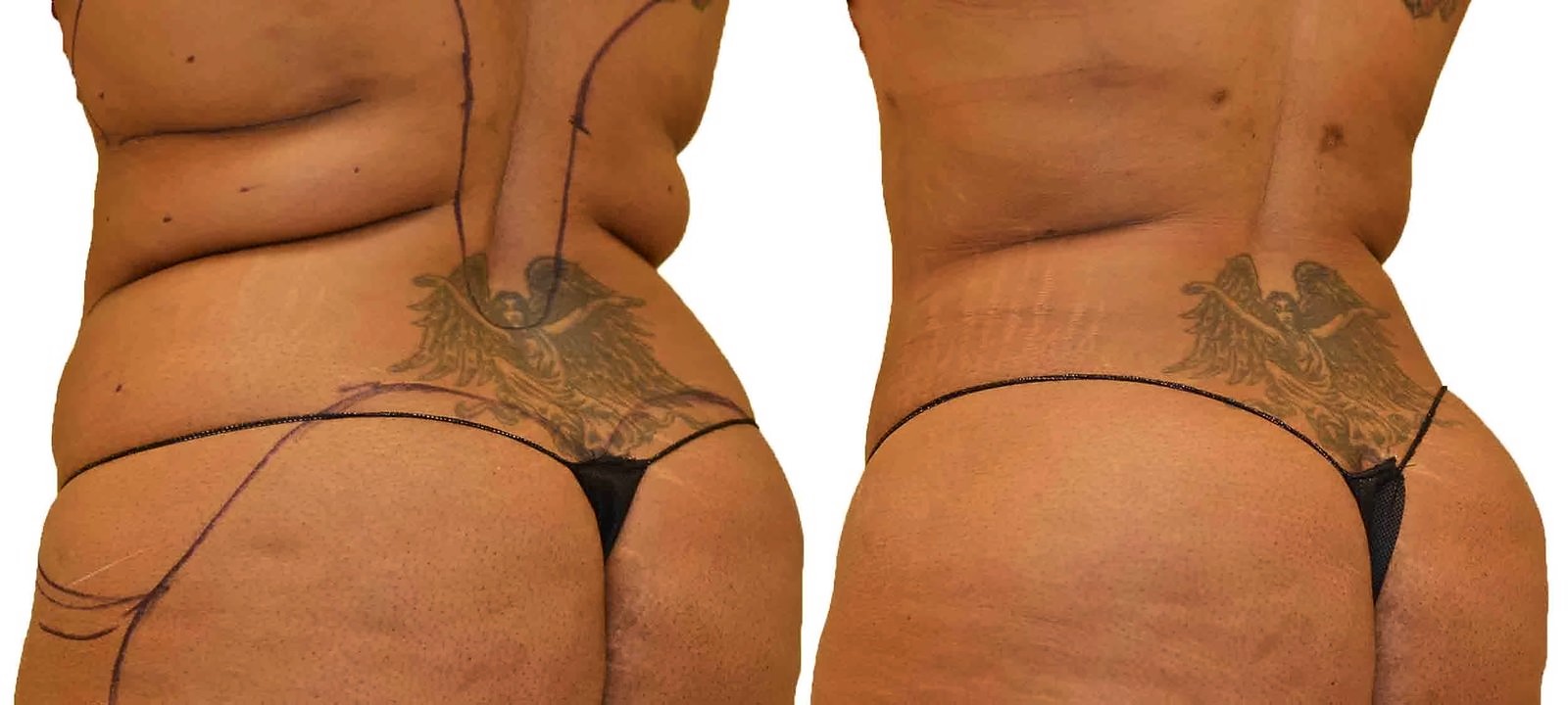 Before/After Fat Transfer, BBL before and after, actual patient of Dr. Long
