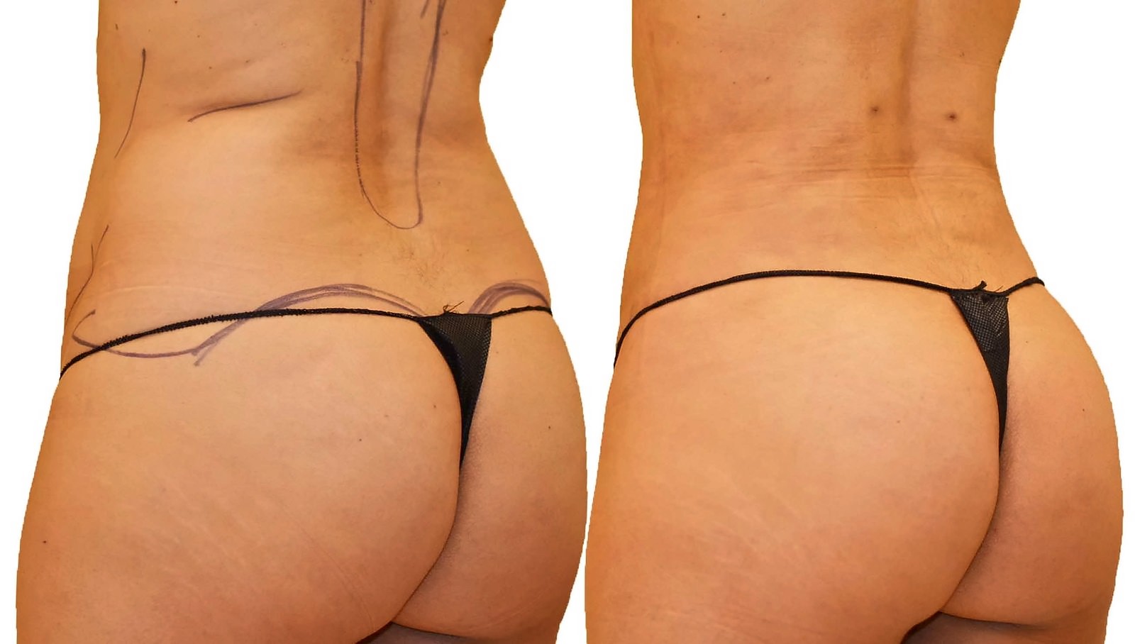 Before/After Fat Transfer, BBL before and after, actual patient of Dr. Long