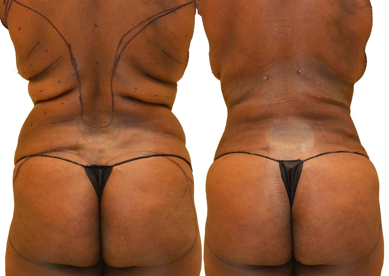 Before/After Fat Transfer, BBL before and after, actual patient of Dr. Long
