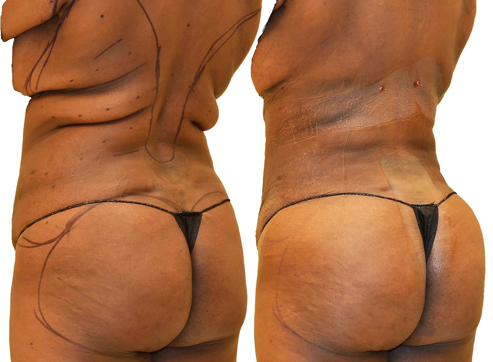 Before/After Fat Transfer, BBL before and after, actual patient of Dr. Long
