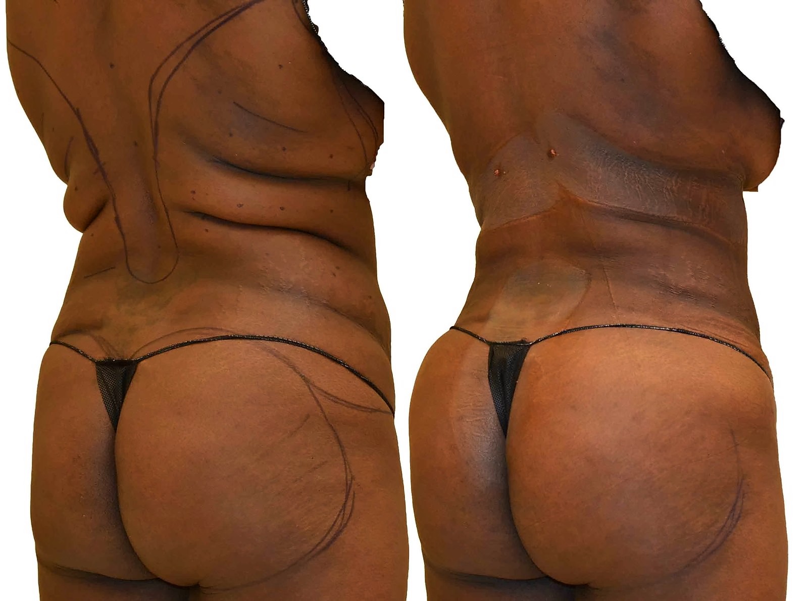Before/After Fat Transfer, BBL before and after, actual patient of Dr. Long