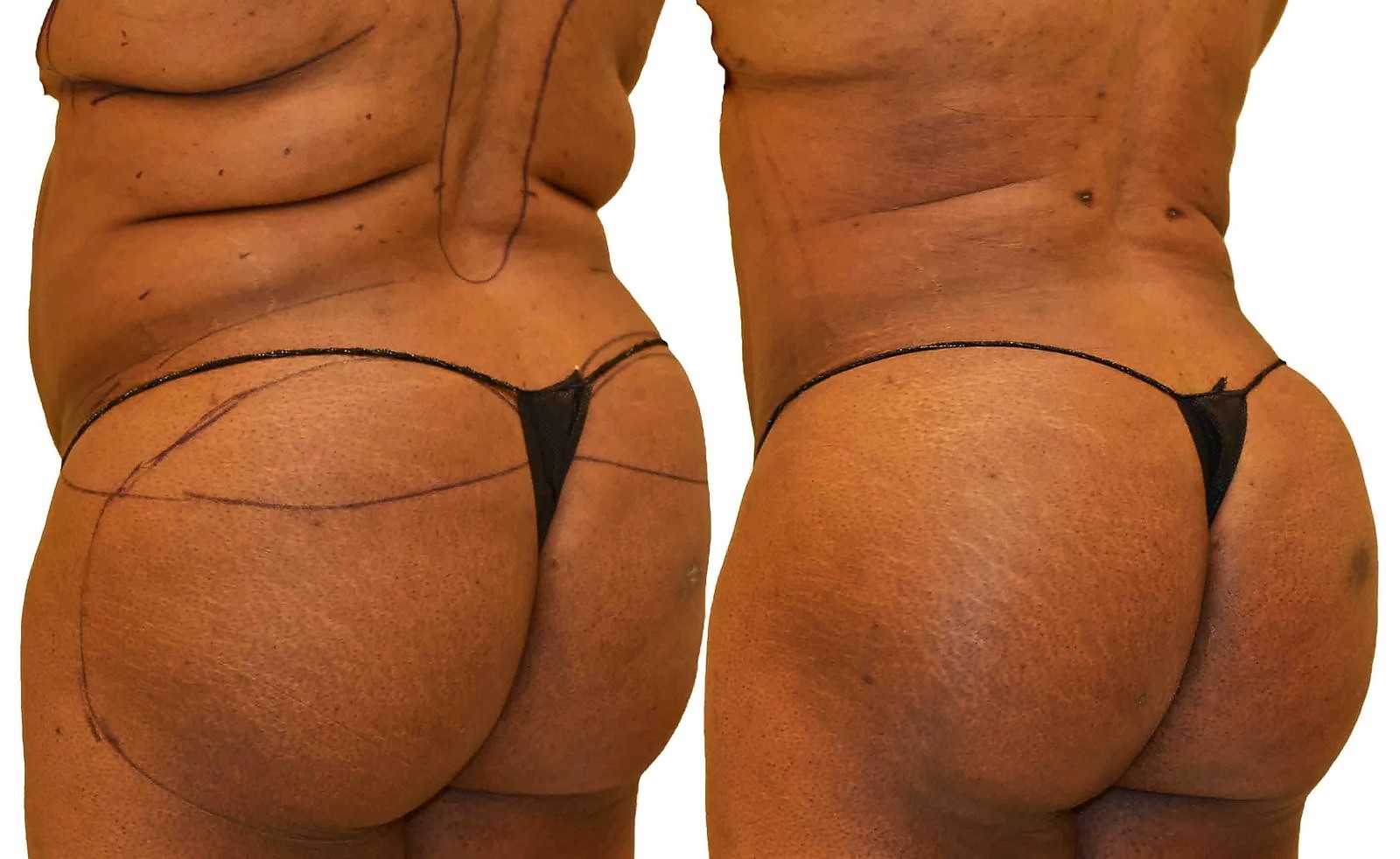 Before/After Fat Transfer, BBL before and after, actual patient of Dr. Long