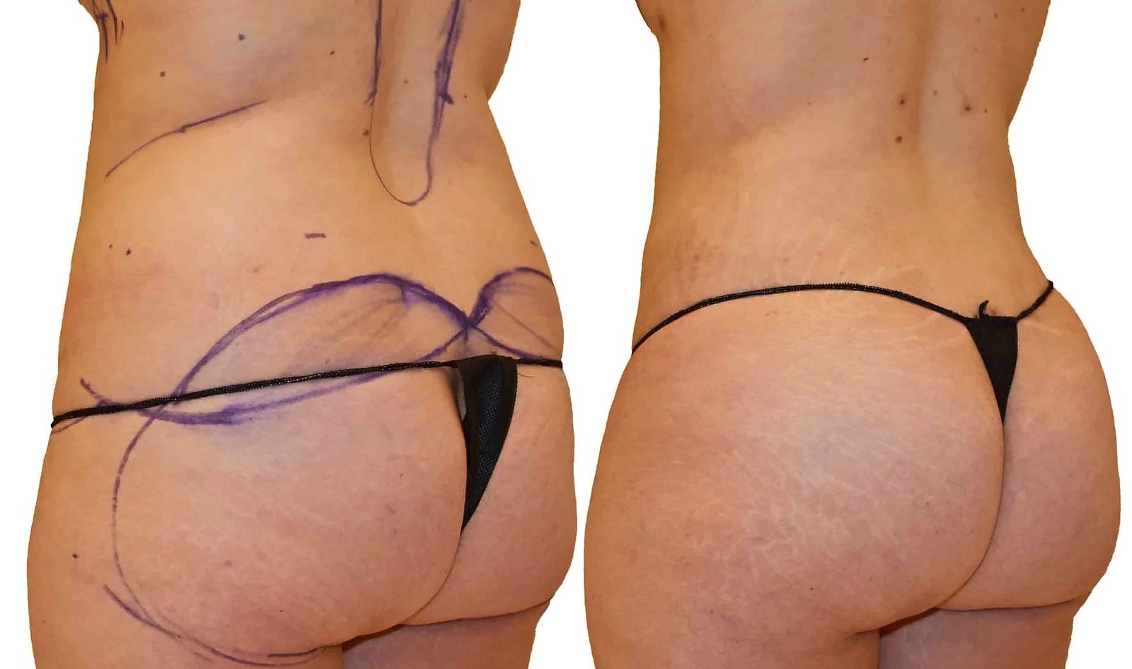 Before/After Fat Transfer, BBL before and after, actual patient of Dr. Long