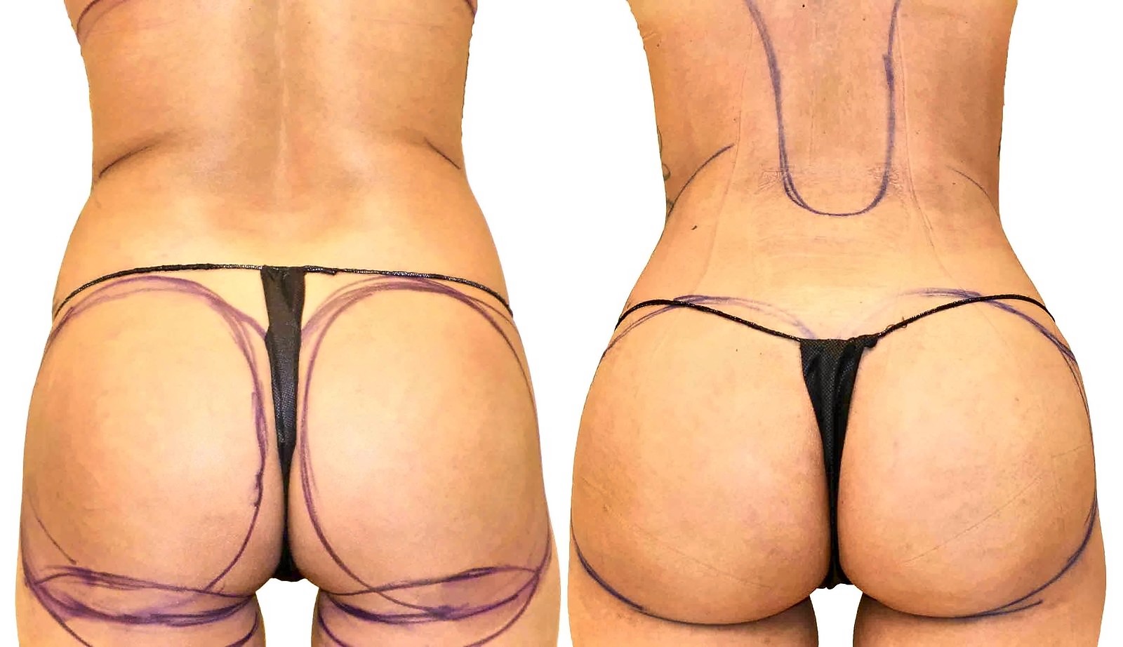 Before/After Fat Transfer, BBL before and after, actual patient of Dr. Long