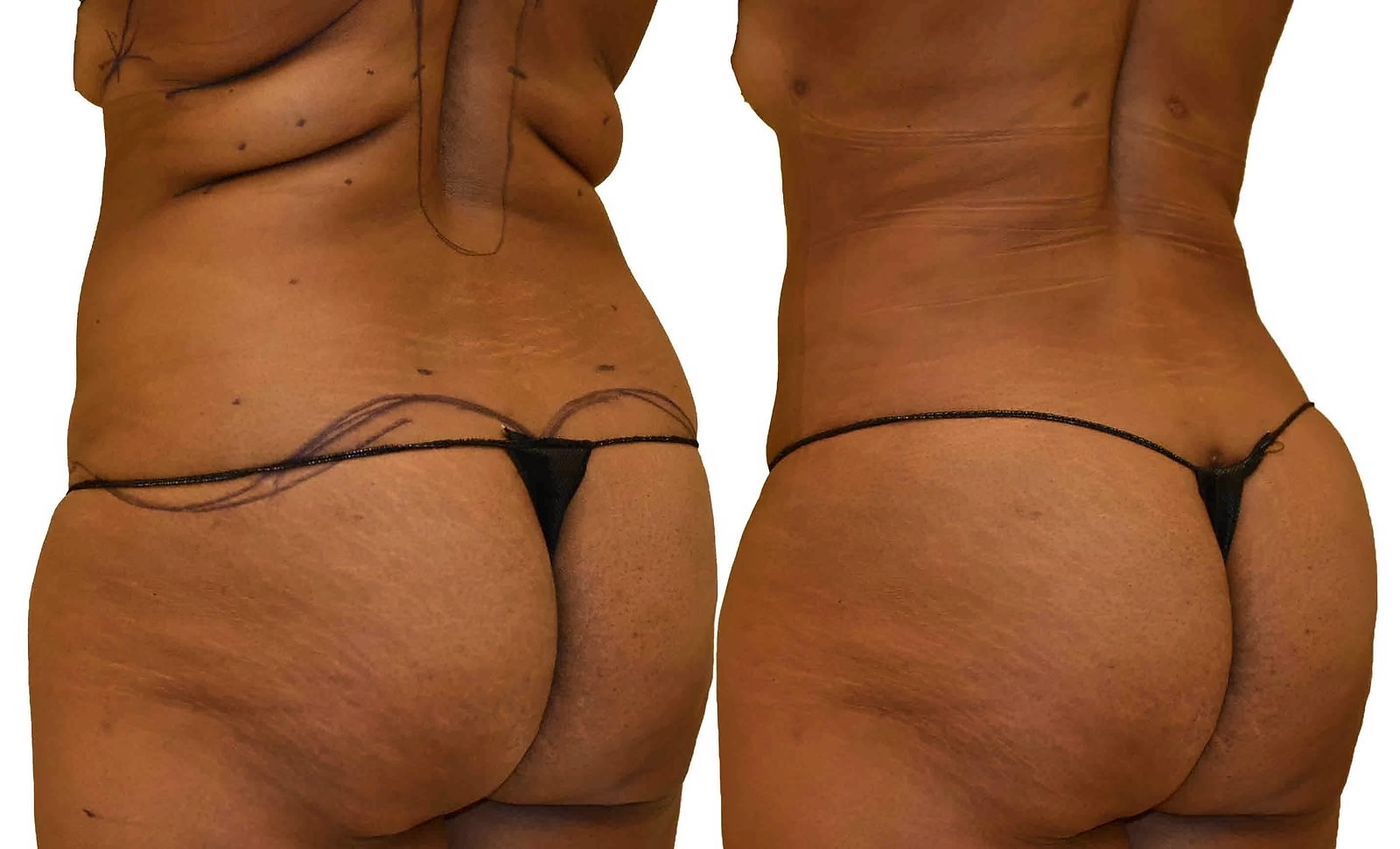 Before/After Fat Transfer, BBL before and after, actual patient of Dr. Long