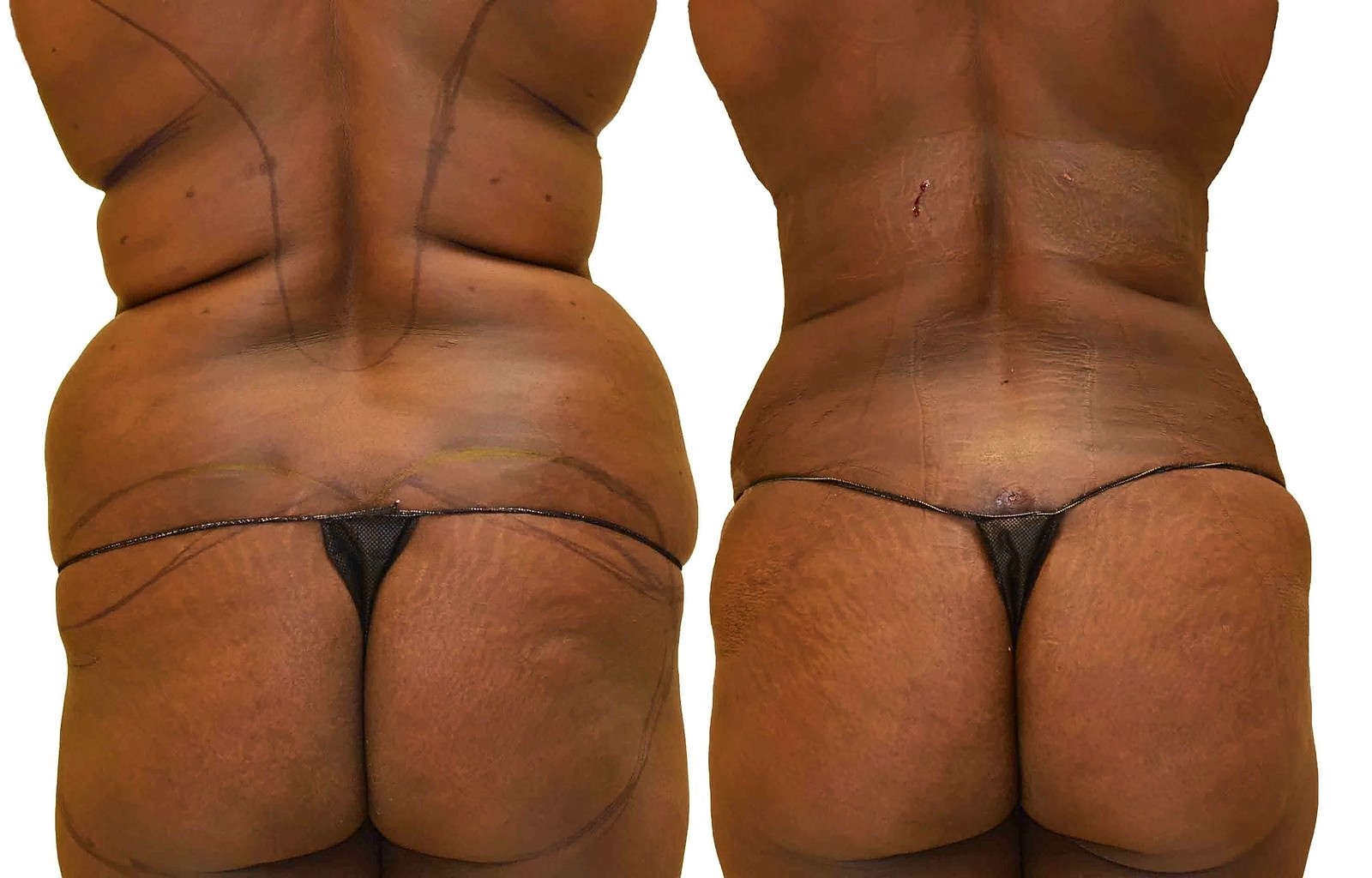Before/After Fat Transfer, BBL before and after, actual patient of Dr. Long