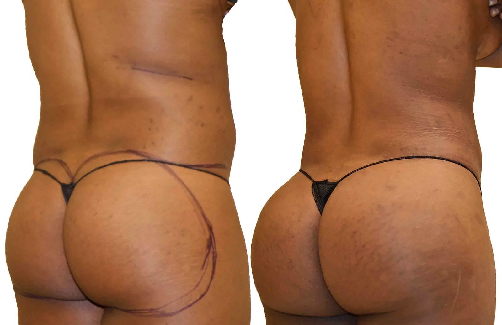 Before/After Fat Transfer, BBL before and after, actual patient of Dr. Long