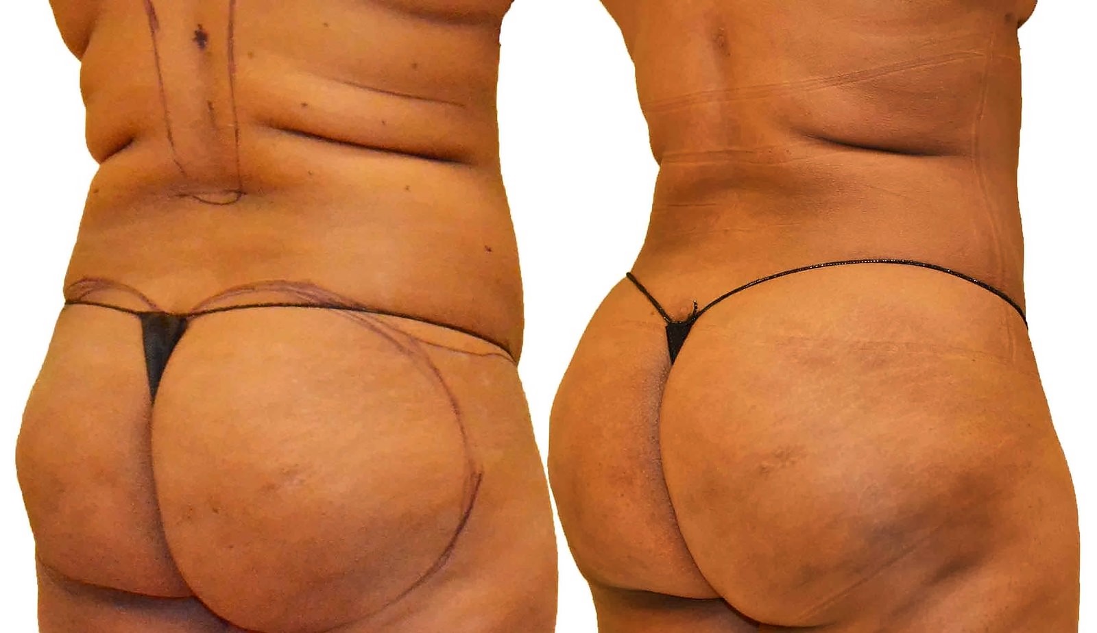 Before/After Fat Transfer, BBL before and after, actual patient of Dr. Long