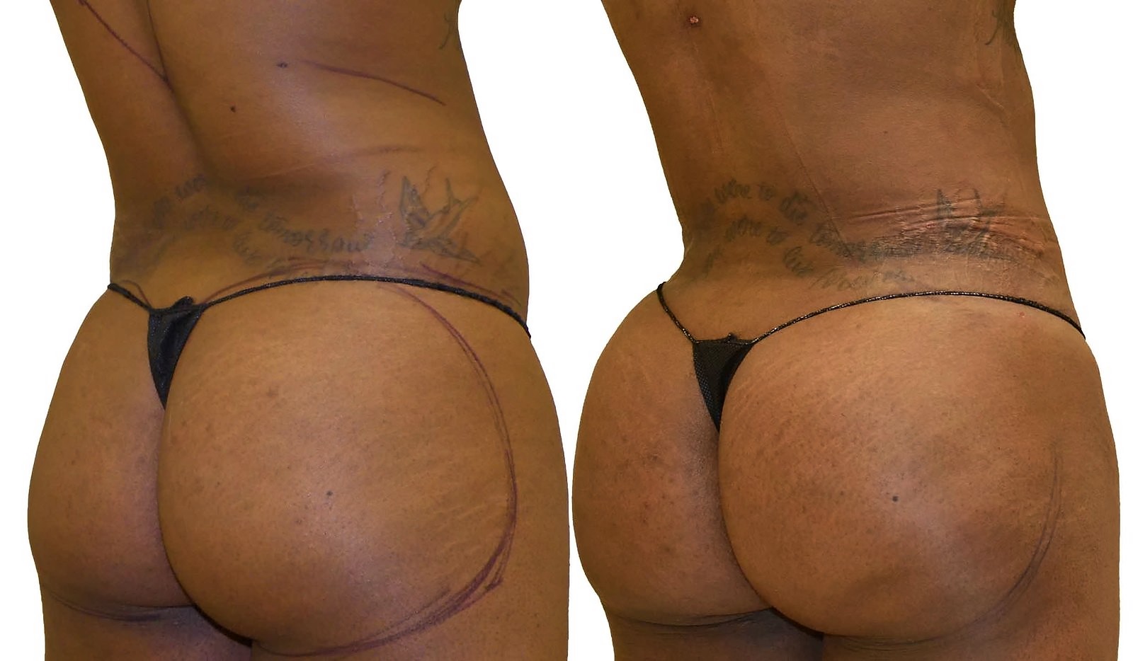Before/After Fat Transfer, BBL before and after, actual patient of Dr. Long