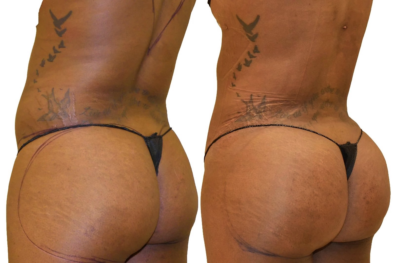 Before/After Fat Transfer, BBL before and after, actual patient of Dr. Long