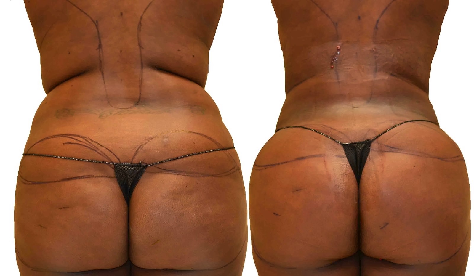 Before/After Fat Transfer, BBL before and after, actual patient of Dr. Long