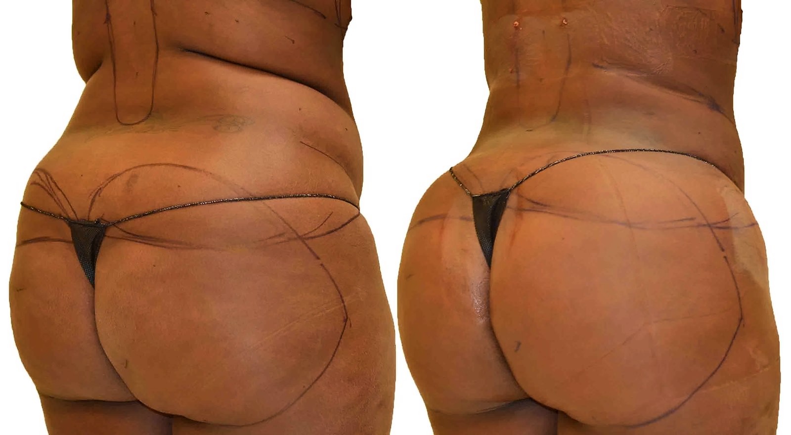 Before/After Fat Transfer, BBL before and after, actual patient of Dr. Long