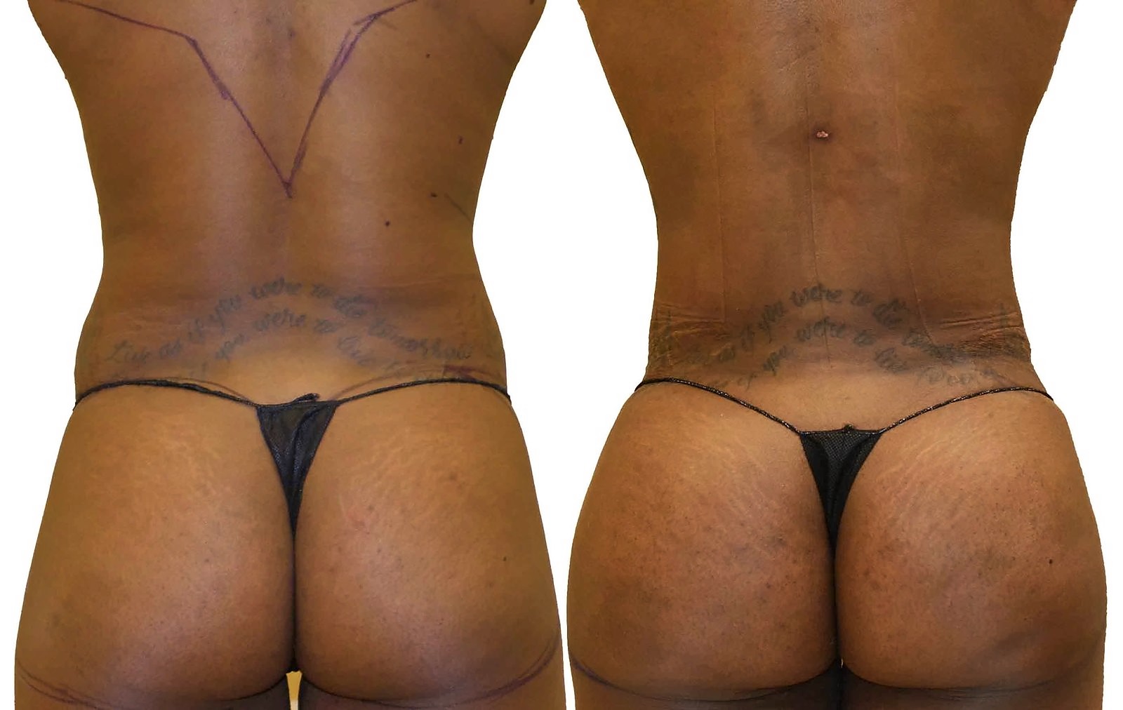 Before/After Fat Transfer, BBL before and after, actual patient of Dr. Long