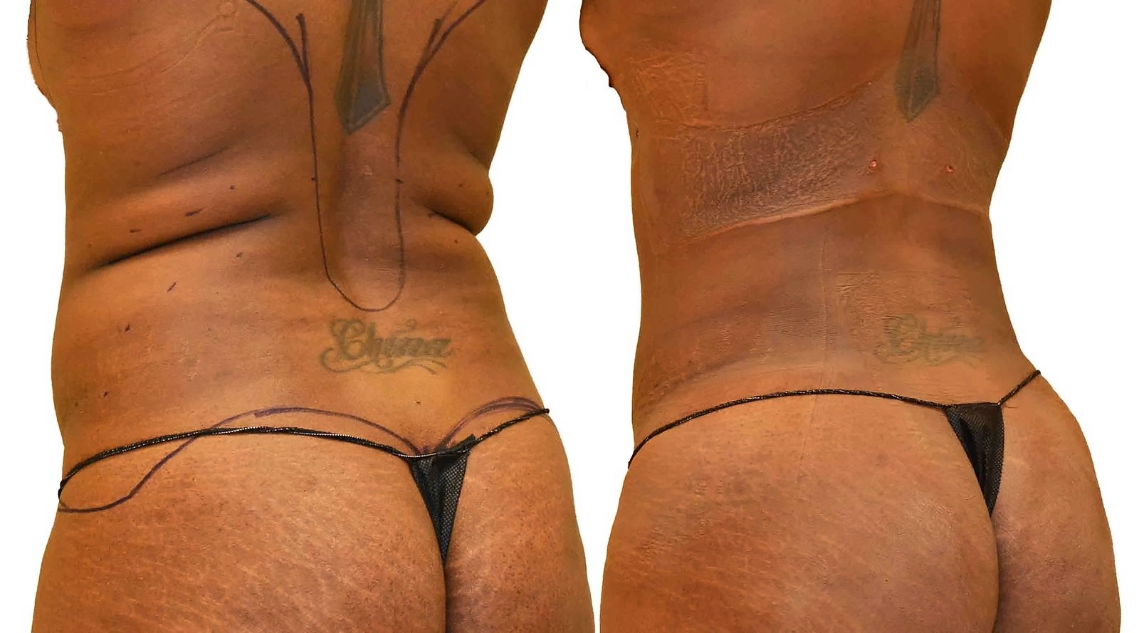 Before/After Fat Transfer, BBL before and after, actual patient of Dr. Long
