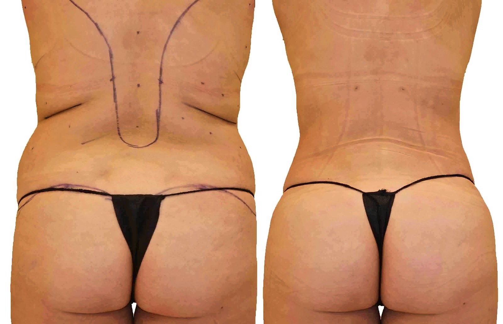 Before/After Fat Transfer, BBL before and after, actual patient of Dr. Long