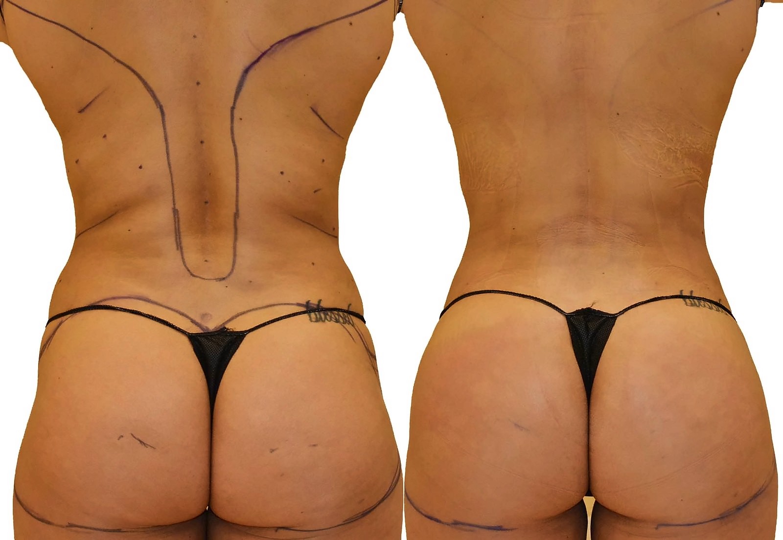 Before/After Fat Transfer, BBL before and after, actual patient of Dr. Long