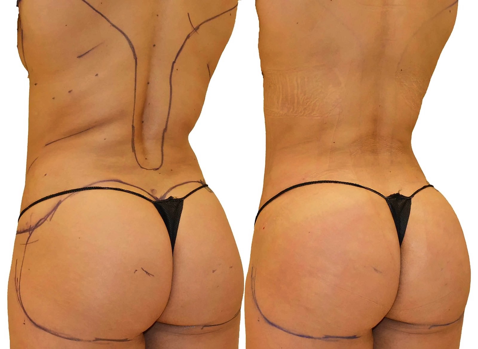 Before/After Fat Transfer, BBL before and after, actual patient of Dr. Long